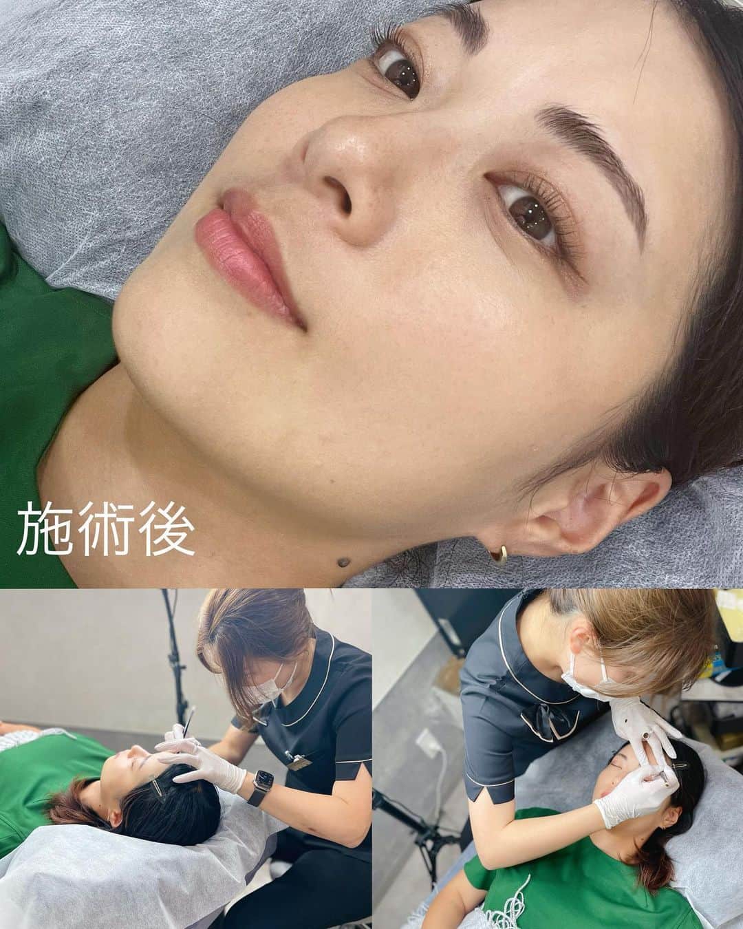 中村優のインスタグラム：「昨年本当にやって良かった眉のアートメイク。一生ものではないけど、簡単に消えるものではないので、慎重にと思いデザインも控えめにしてもらっていました。  去年秋に施術してから、眉メイクはほとんどすることなく、すっぴんでも自然な眉なので大満足✨✨ ただ、眉山のあたりはもう少し足してもいいかなという気持ちになったので、再び細田さん @hosodakiyoko_artmake にお願いすることに。  ほんの少し足すだけだったので、書いてる時間はあっという間に終わりました🙌🏼 @the_artmake_tokyo  @dr.nishikawa  クリーム状の麻酔をしてからの施術だから全く痛くないです🙆🏻‍♀️本当におすすめ❤️‍🔥❤️‍🔥」