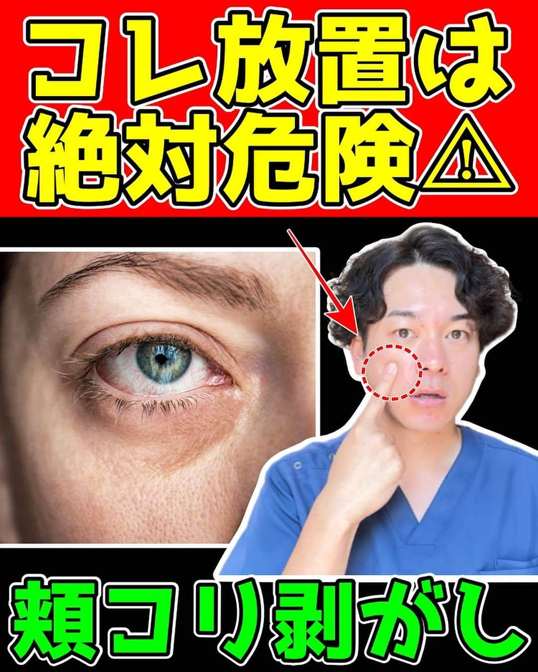 かず先生のインスタグラム：「『10歳若返りを目指す人を育成して自分に自信を持ってもらう』をモットーに誰でも簡単に出来る若返りセルフケアを学ぶことが出来ます！！  ほうれい線・顔のたるみ・目のたるみなどの美容系のお悩みの解消はもちろん、姿勢矯正して、痛みを解消する事も 『若返り』と思うので美容以外のお悩みがある方でも参考になると思います✨  まだまだ諦めないでください！！  僕と一緒にコツコツとセルフケアを頑張りましょう！！  必ず10歳若返って自分に自信が持てるようになりましょう🔥  ーーーーーーーーーーーーーーーーーーーーー 【かず先生のプロフィール】  ■国家資格の柔道整復師の資格を取得後、大阪の整骨院で分院長として８年間勤務する。  自分の思い通りに施術が出来ない保険治療に嫌気が差し、  2017年に地元である和歌山県で自費治療の整体院紡ぎを開業する。  毎月150人以上の患者様に来院して頂き、日々痛みや美容で悩んでいる方のサポートを行っている。  【実績紹介】  ■YouTube登録者数　38万人(2023年　8月現在)  ■Instagramフォロワー数　28万人(2023年　8月現在)  ■TikTokフォロワー数　27万人(2023年　8月現在)  ーーーーーーーーーーーーーーーーーーーーー  ✨毎日たった1分やるだけで『10歳若返る』簡単セルフケアを配信中✨  実践したら🙌🙌で教えて下さいね🥰  共感、応援してくださる方はフォローお願いします🥰  後から繰り返し見たい人は👆【保存マーク】  今回の内容が参考になったら👍【いいね】  個人的に何が質問があればDMお願いします✨  ーーーーーーーーーーーーーーーーーーーーー  ✨整体院紡ぎ-TSUMUGI-✨ 【和歌山県橋本市/橋本ICから車で7分】  ●体の不調でお悩みの方はプロフィール リンクからお問い合わせください(^^)  ●お悩みをしっかり伺い痛みの原因を探ります ●根本から解消！！【施術・セルフケア・生活習慣サポート】 ●腰痛・五十肩・股関節痛・膝痛など  ———————————————————————  #ほうれい線 #瞼のたるみ #目の下のたるみ #ゴルゴライン」