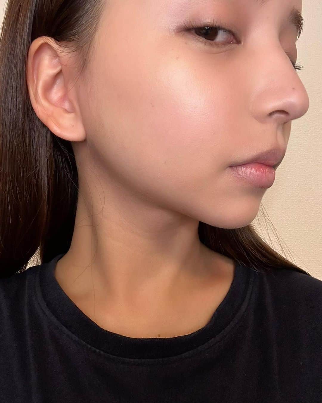 平尾優美花（ゆみちぃ）さんのインスタグラム写真 - (平尾優美花（ゆみちぃ）Instagram)「先日、@tclinic_shinjuku でハイフのリニアモードやってきた🏥 直後もだけど最近また更に効果感じてきたの！ 顎下のたるみ？お肉？どちらにせよ、引き締まってくれて嬉しい🥲🫶🏻  左右差が気になってたけど先生が親身に黄金比を考えて施術してくれた🌷 HIFUも打つ人や機会で変わってくるものだから、慎重に！仕上がり満足〜  キャミは @gu_for_all_ デニムは @grl_official  キャップは @snidel_official と @newerajapan コラボ🧢」9月2日 21時05分 - hirao_yumika