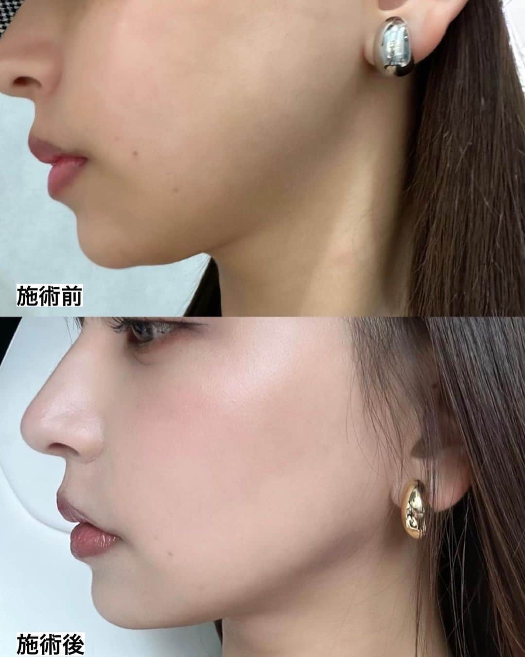 平尾優美花（ゆみちぃ）さんのインスタグラム写真 - (平尾優美花（ゆみちぃ）Instagram)「先日、@tclinic_shinjuku でハイフのリニアモードやってきた🏥 直後もだけど最近また更に効果感じてきたの！ 顎下のたるみ？お肉？どちらにせよ、引き締まってくれて嬉しい🥲🫶🏻  左右差が気になってたけど先生が親身に黄金比を考えて施術してくれた🌷 HIFUも打つ人や機会で変わってくるものだから、慎重に！仕上がり満足〜  キャミは @gu_for_all_ デニムは @grl_official  キャップは @snidel_official と @newerajapan コラボ🧢」9月2日 21時05分 - hirao_yumika