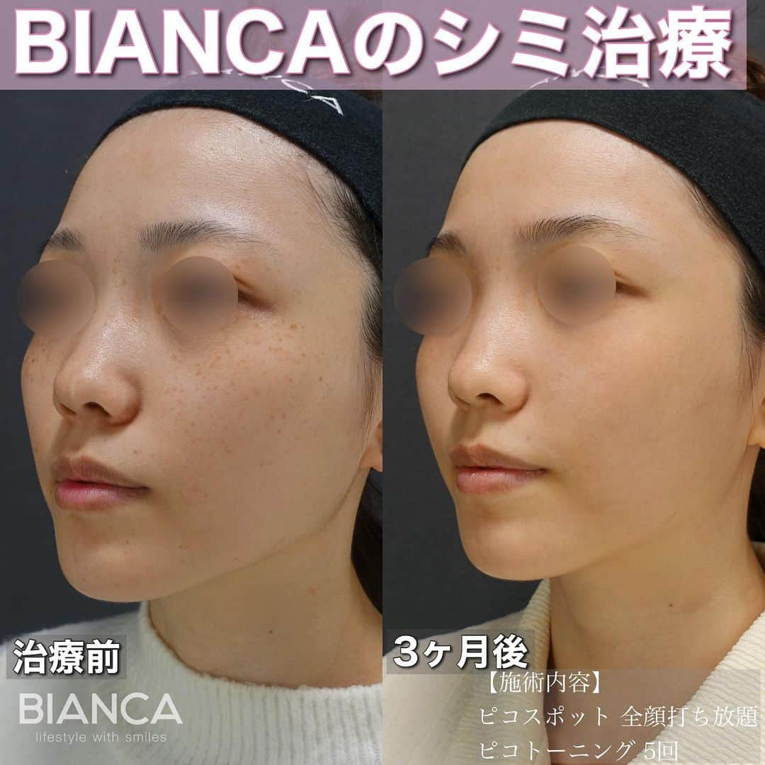 辻沢由有（BIANCA CLNIC 表参道院 院長）のインスタグラム：「#dryuu肌 ▶︎swipeで文字なし写真▶︎ 【これぞBIANCAメソッド🌟】  左 治療前 右 スポット照射 ＋トーニング5回後  シミが綺麗になったのはもちろん 回を重ねるごとに見違えるほど トーンアップ＆肌質も改善しています✨  1人で悩んでいる時間はもったいないです❗️😵 気になる方は是非カウンセリングにお越しください👩‍⚕️  🌸ピコスポット全顔打ち放題 税込 17,908円 🌸ピコトーニング 税込 118,580円 🌸各種栄養療法 🌸スキンケア指導  ✽.｡.:*・ﾟ ✽.｡.:*・ﾟ ✽.｡.:*・ﾟ ✽.｡.:*・ﾟ ✽.｡.:*・ﾟ  📝ご予約はwebが便利です✨ プロフィール欄のリンクからご予約ください。 ※医師指名可能（“大久保医師指名”をクリック） ※診察料はかかりません🙅‍♀️ ※表参道院勤務が9割となっています。  📍BIANCA CLINIC ※お電話頂くと自動音声通話に繋がります。 ✔︎表参道院 ☎️05018071593 東京都港区南青山5-11-10  南青山511ビル 2F ✔︎銀座院 ☎️05031964834 東京都中央区銀座1-8-19 キラリトギンザ12F  •診療時間 10:00〜19:00 •年中無休（年末年始を除く）   ✽.｡.:*・ﾟ ✽.｡.:*・ﾟ ✽.｡.:*・ﾟ ✽.｡.:*・ﾟ ✽.｡.:*・  #美容外科 #美容皮膚科 #美容整形 #美肌  #アンチエイジング  #ピコシュア #ピコトーニング  #シミ取り #そばかす #シミ治療  #ソバカス #スキンケア #美白」