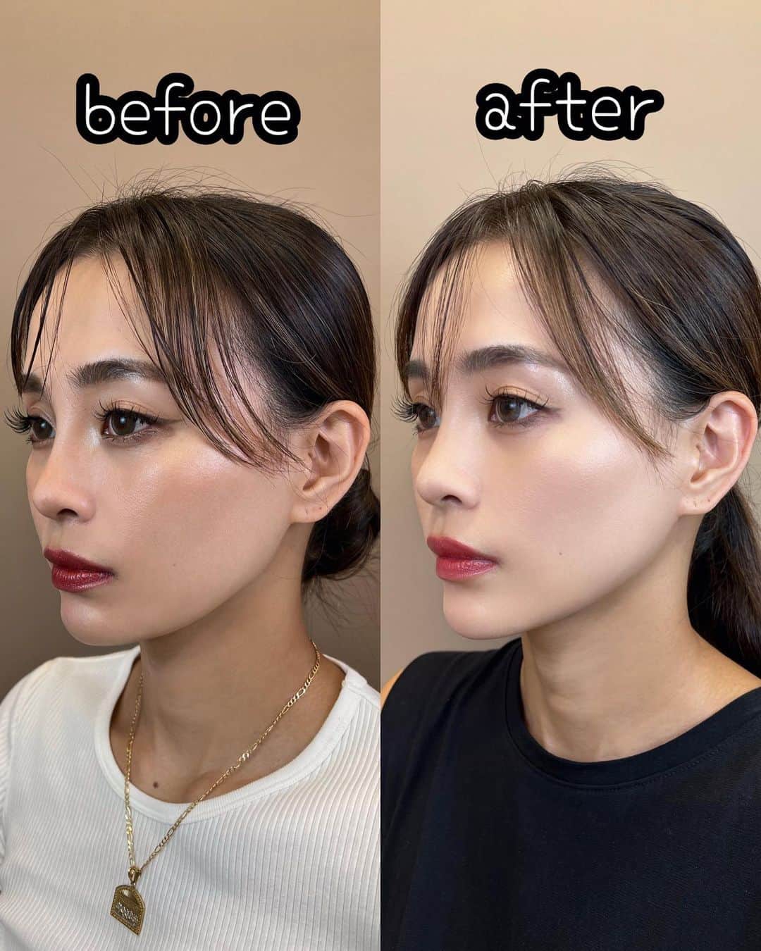 yumiさんのインスタグラム写真 - (yumiInstagram)「. やっほゆみだよ📚 東京中央美容外科銀座二丁目院【 @tcb_ginzanichoumein 】でひかり先生【 @tcb_hikari_sato 】【 @tcb_dr.hikari_shourei 】にTCB式小顔美肌再生をやってもらって1カ月経ちました！👨🏻‍⚕️  今や何の違和感もなく過ごしてる🌱 馴染んできたのか「小顔になった？」と最近言われるようになりましたー👸🩷 気付いてもらえるの嬉しいー！！ . ひかり先生は元脳外科医で専門医と医学博士の資格を持ってるの💉📚 なので安心して受けれました👨🏻‍⚕️💉 ありがとうございました！ . 予約の際YUMIのインスタ見たと伝えると良いことがあるよーん📣✨ . . #東京中央美容外科  #東京 #銀座 #佐藤光 #ひかり先生 #糸リフト #小顔整形 #tcb式小顔美肌再生  #PR」10月4日 17時50分 - yumiiiiiiiii_
