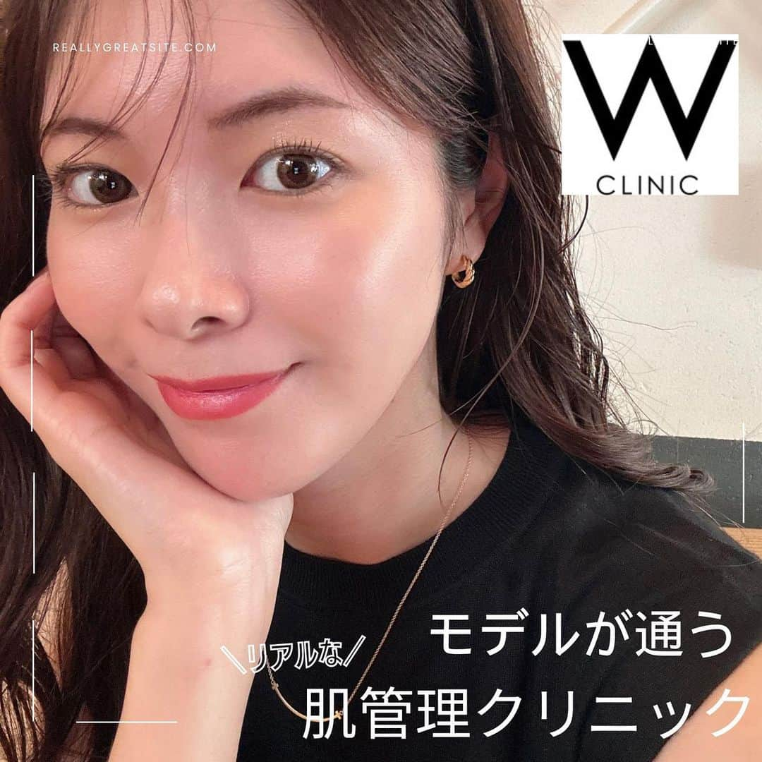 Yuika Matsuさんのインスタグラム写真 - (Yuika MatsuInstagram)「美容💓 　 @w_clinic_ 様で２回目の  ▪︎ ハリとツヤがあり潤いのある若々しい肌になる ＜水光注射> ▪︎レーザー治療 <PTPトーニング＞ 　 をしてきました✨ 今回施術をしたのは @w_clinic_ 梅田院。 　 投稿の度に綺麗な院内ですねー！と 言ってもらえるんですが そうなの🩷オシャレで通いやすいです🥰  　 @nao.7015 先生に肌のくすみと ニキビ跡などカウンセリングして頂き 　 今回の水光注射では、 シミやニキビ跡に効くような 美容液を多めに入れてもらいました✌️  → 水光注射とは内から輝くような お肌を作る成分を真皮や表皮に直接 細かく注射して入れ込めれるんです💉 　 効果的は▶︎お肌の水分補給・くすみの解消・ 弾力性の向上・シワ・小ジワの改善に効果的らしいです🎯 　 次の日、お肌の艶感が爆発してたので 撮ったのが1枚目の肌です♪ 　 お馴染みのPTPトーニングも 細かいシミ対策に！！ これで消えてくれたら嬉しい🥴 　 　  #wクリニック#wフェミナクリニック #レディースクリニック大阪  #美肌治療#美容医療 #乾燥肌改善#美肌作り#美肌再生 #潤い肌#潤い美肌#小じわ改善 #ニキビ改善#美肌計画#艷肌#PR」10月1日 17時57分 - yuika00802