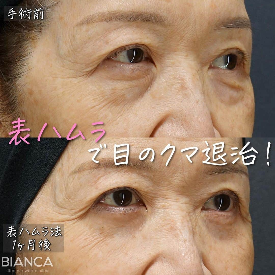 辻沢由有（BIANCA CLNIC 表参道院 院長）のインスタグラム：「【ハムラ法でクマ治療🐻】  ハムラ法とは、目の下にある眼窩脂肪を目の下のくぼみに移動させることで、目の下のたるみとくぼみを同時に改善する治療です。余分な眼窩脂肪は除去し、適量を移動させて固定させるので、凹みが目立ちにくく、若々しい目元を実現できます  ✽.｡.:*・ﾟ ✽.｡.:*・ﾟ ✽.｡.:*・ﾟ ✽.｡.:*・ﾟ ✽.｡.:*・ ✔︎表ハムラ法　税込602,580円  ▶︎麻酔:局所麻酔もしくはリラックス麻酔 ▶︎ダウンタイム:腫れ・内出血などが1週間程度 ▶︎抜糸:1週間後  ✽.｡.:*・ﾟ ✽.｡.:*・ﾟ ✽.｡.:*・ﾟ ✽.｡.:*・ ﾟ✽.｡.:*・ﾟ  📝ご予約はwebが便利です✨ プロフィール欄のリンクからご予約ください。 ※医師指名可能（“大久保医師指名”をクリック） ※診察料はかかりません🙅‍♀️ ※表参道院勤務が9割となっています。  📍BIANCA CLINIC ※お電話頂くと自動音声通話に繋がります。 ✔︎表参道院 ☎️05018071593 東京都港区南青山5-11-10  南青山511ビル 2F ✔︎銀座院 ☎️05031964834 東京都中央区銀座1-8-19 キラリトギンザ12F  •診療時間 10:00〜19:00 •年中無休（年末年始を除く）   ✽.｡.:*・ﾟ ✽.｡.:*・ﾟ ✽.｡.:*・ﾟ ✽.｡.:*・ﾟ ✽.｡.:*・ﾟ  #ハムラ法 #表ハムラ #裏ハムラ #クマ取り #目の下のクマ #目の下のたるみ #目の下のたるみ取り」