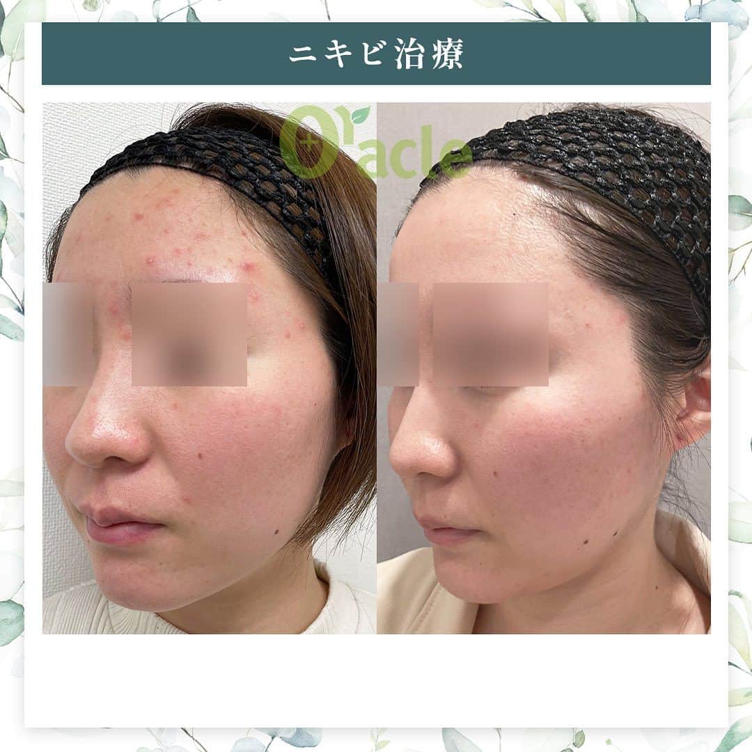 オラクル美容皮膚科東京新宿院さんのインスタグラム写真 - (オラクル美容皮膚科東京新宿院Instagram)「◤ニキビ治療◢| ☞繰り返していたおでこのニキビが改善  《治療内容》 アグネス全顔5回 美白管理5回 ※炎症のニキビが治まって後は、定期的なピーリングで皮脂コントロールをし予防がおすすめです。  ☑️アグネス ニキビの原因となる皮脂腺を直接破壊し、破壊した毛穴からの再発を半永久的に防ぐニキビの根本治療です。 ビリビリしたお痛みがあるので、麻酔をして痛みを軽減させます。 ⁡ 【ダウンタイム】 赤み：2~3日 腫れ：数日～2週間ほど出る方もいる 内出血：1~2週間 洗顔、メイクは翌日以降◎ ⁡ 【料金】 ☞初回部分　19,800円 ☞部分通常　22,000円 ①こめかみ片側 ②鼻（眉間〜鼻） ③顎 ①②③のいづれか1箇所  ☞⁡半顔　44,000円 ①額全体 ②頬片側 ③顎下～首 ①②③のいづれか1箇所  ☞全顔　66,000円 ※別途、麻酔代2,200円  ☑️美白管理 ニキビのお肌は乾燥している方が多く、その乾燥がニキビの原因になっているいることも… 美白管理では、お肌の状態に合わせてビタミンＣ、もしくはトラネキサム酸をお肌に導入していきます。 ⁡ 【料金】 1回　11,000円(税込)  ※薬剤込▶︎トラネキサム酸orビタミンC ☞肌状態でお選びいたします。 ⁡ #アグネス　#高周波 #ニキビ治療 #ニキビ肌 #ニキビ跡 #ニキビケア #ニキビ肌 #ニキビ肌改善 #美肌 #肌質改善 #ニキビ皮膚科」10月2日 18時10分 - oraclejp