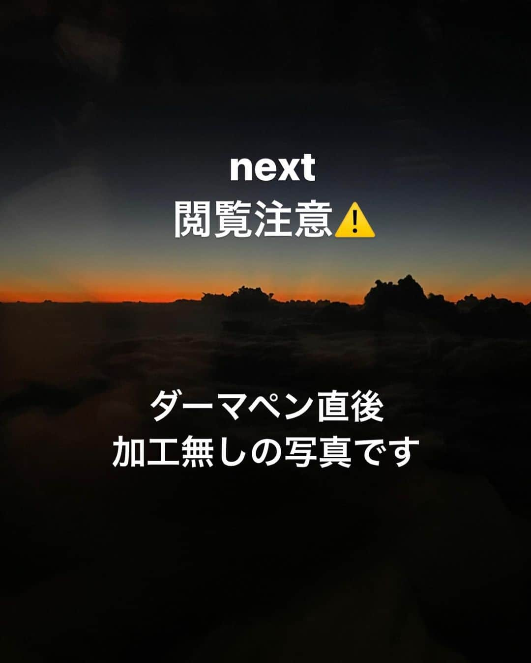 𝐂𝐎𝐂𝐎𝐍𝐀さんのインスタグラム写真 - (𝐂𝐎𝐂𝐎𝐍𝐀Instagram)「ダーマペン3回目✒️  最近、嬉しい事にお肌何してるの？ ダーマペンて何？ て、沢山聞いて貰える🐥 から、載せておきます  因みに私は 気になってた毛穴が見てわかる 位引き締まった♡ あと、前より化粧崩れもしなくなった💡  まず、ダーマペンて何？ 超極細針で肌の表面に目に見えないほどの小さな穴を一時的につくります。 その時皮膚が傷を修復しようとする 自然治癒力を促し、ターンオーバー を正常な状態に導いたりする効果が あります。  効果 ・毛穴の開き ・くすみ ・しわ ・たるみ (回復を重ねればクレーターにも)  私がやったのは、ダーマペン4 施術中、直後も載せてあるから 是非見てね。 経過も、リールとハイライトに 残してあります🐣  お肌の調子絶好調🥚 ダーマペンは(個人差あり) 私は、1回目から引き締まった感じがしてた🙊  私は、池袋レーザークリニック @ikebukurolaserclinic0201  でやってもらったよ お値段もお手頃で、すごく丁寧🥹  他にも気になる事あれば是非 コメント欄で質問して下さい🙋🏼‍♀️  #ダーマペン4 #ダーマペン #ダーマペン経過 #肌質改善 #美容医療 #アンチエイジング効果 #アンチエイジング #毛穴レス #たるみ毛穴改善 #美肌作り #ダーマペン治療 #レーザー治療」10月4日 11時56分 - cocona_66