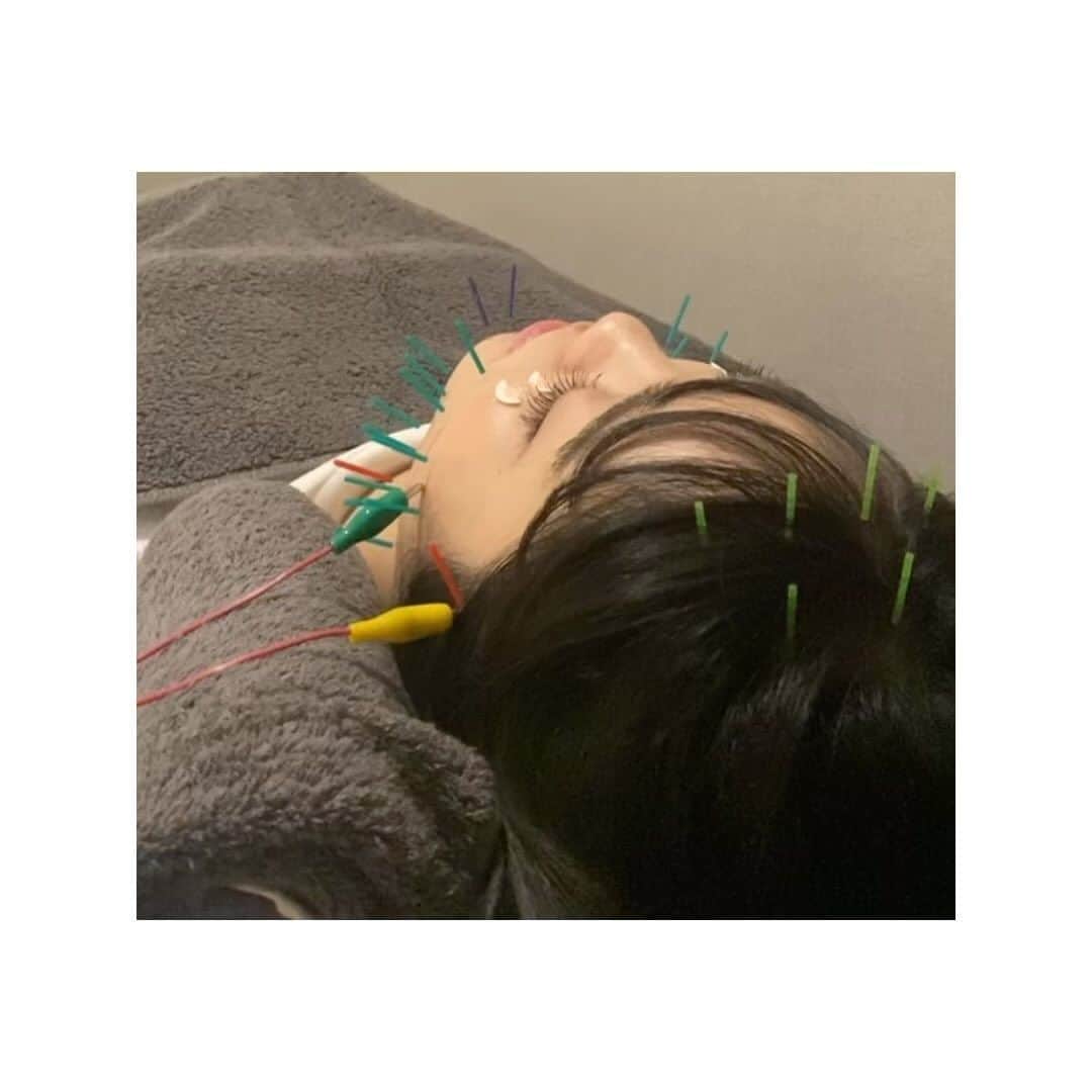 佐藤日向のインスタグラム：「. 初美容鍼！！！ 顔のむくみ取れますように🙏🙏🙏 顔に鍼ささってるのおもしろいよね笑 #promotion」