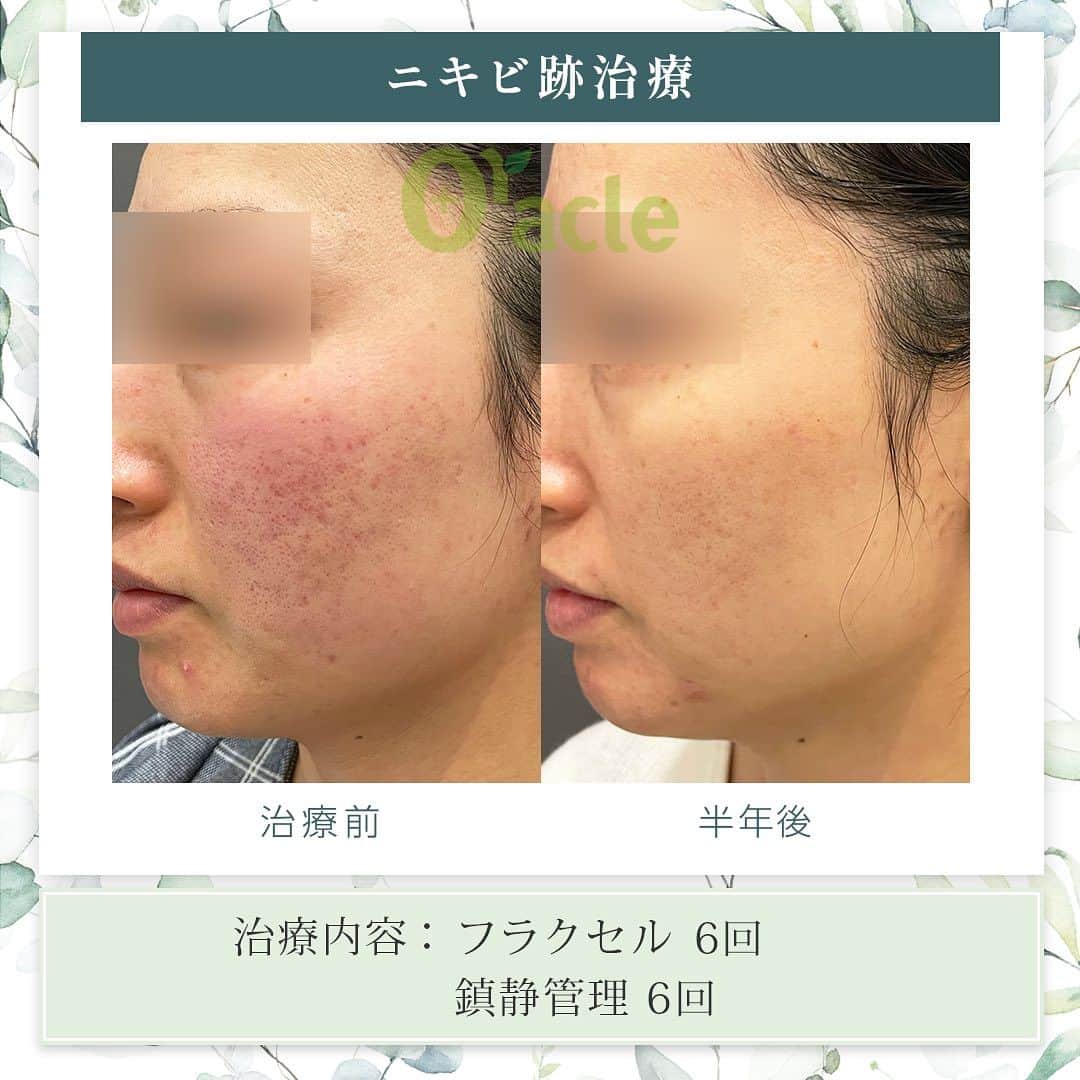 オラクル美容皮膚科東京新宿院さんのインスタグラム写真 - (オラクル美容皮膚科東京新宿院Instagram)「|◤毛穴、ニキビ跡治療症例◢|  《治療内容》 フラクセル6回 鎮静管理6回 ☞お肌が荒れている方は鎮静管理がマスト！！ 赤みが強く乾燥されていたため鎮静と保湿もしっかりセットで行いました。  ☑️フラクセル 1回の治療でお肌の5〜15%を入れ替えるレーザー治療  【ダウンタイム】 赤み：2〜10日 浮腫み：出る方もいる 皮剥け：5〜7日 洗顔、メイクは翌日以降 ⁡ 【料金】※税込み ▶︎フラクセル1回19,800円 麻酔代2,200円  ▶︎鎮静管理　1回11,000円　 →オプションの場合7,700円 フラクセル後はお肌に熱がこもった状態になります。マイナス15度で冷やしながら鎮静保湿成分を導入する韓国式の治療です。 ⁡ #ニキビ跡　#赤ら顔 #ニキビ跡治療 #フラクショナルレーザー #ニキビ皮膚科 #皮膚科 #美肌 #フラクセル #毛穴　#毛穴引き締め」9月12日 16時43分 - oraclejp