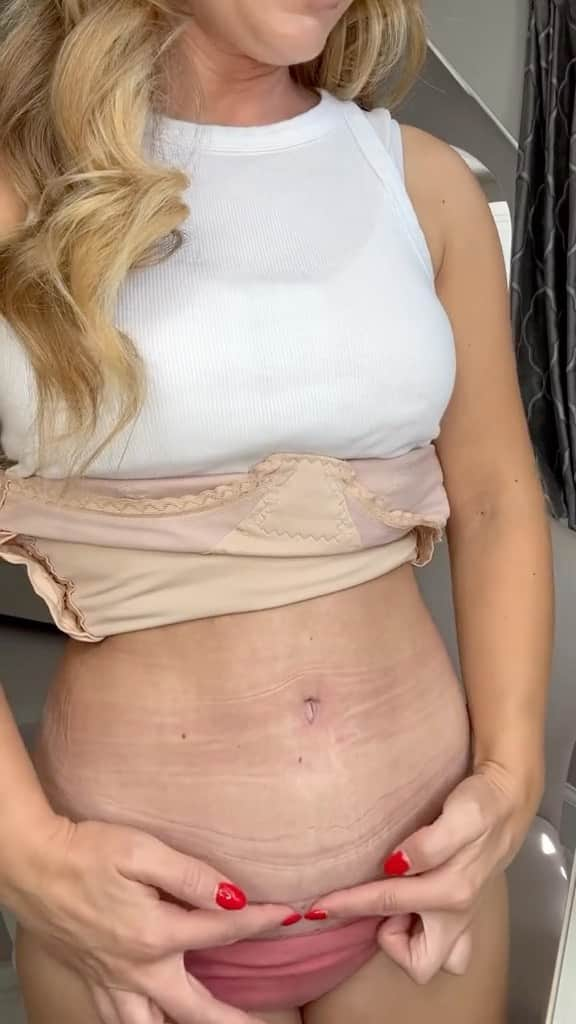 Anna Sacconeのインスタグラム：「5 weeks post op! 🥳 #tummytucksurgery #tummytuck #tummytuckjourney #plasticsurgery #mommymakeover #annasaccone #diastasisrecti #diastasisrepair #liposuction #lipofilling #breastlift #tummytuckrecovery #momof4 #fattransfer」