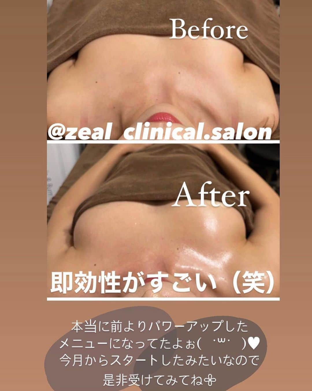 岩下えみさんのインスタグラム写真 - (岩下えみInstagram)「⁡ ⁡ @zeal_clinical.salon  さんの 最強3Dバストアップメニューが 今月からさらにパワーアップしたみたいなので 早速受けて来たよ〜🫶🏼😻♥︎ ⁡ ⁡ グローブマシンで肩甲骨周りを しっかり解してもらうよ𖧷 この辺りの筋肉が張ってると おっぱいがひっぱられて 流れちゃうんだって🥹💦 ⁡ ただただ気持ちよかった〜𖧷( ˙꒳​˙ ) ⁡ からのEMS！ これもすごかった✨✨ してもらってる時からハリ出て 元気になってるのがめっちゃ分かる🥰 胸周りの筋トレも大事だねぇ〜♪ ⁡ ⁡ そしてそしてっ @seinsmous さんの 脂肪が増える美容液を導入🤍 この導入する機会がパワーアップしたお陰で 前の１０倍もの浸透率が上がったの♥️♥️ 本当にすごい！🫶🏼 ⁡ これも是非みんなに 受けてみて欲しい( ᐛ)🙏🏽 ⁡ ⁡ いつもありがとうございます🫠💓 ⁡ @mmk_miura  ⁡ 〠大阪市中央区南船場3-3-3  801号室 ☎︎066-226-7754 ⁡ #セインムー #バストアップ #最強3Dバストアップ #キャビゼロ #ウルトラマジックボディhifu #最新痩身マシン #ZEALクリニカルサロン #大阪エステサロン  #痩身エステ #美肌エステ #ハイフ #リフトアップ #脂肪吸引 #美容クリニック #南船場エステ #心斎橋エステ #ダイエット #エステダイエット」9月15日 20時25分 - emii114