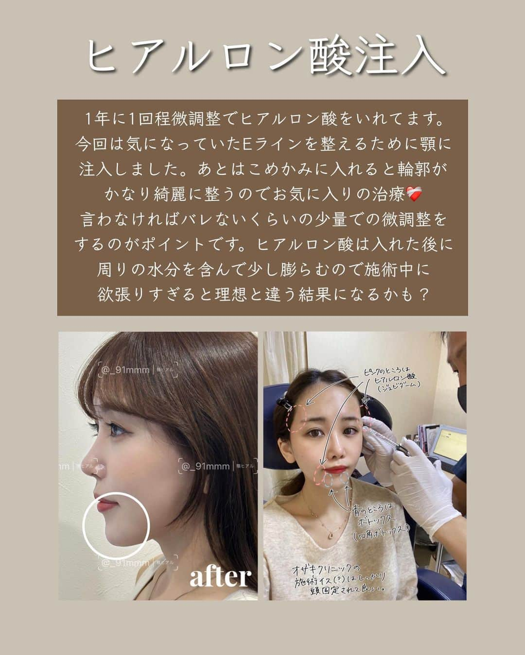 みちかさんのインスタグラム写真 - (みちかInstagram)「アラサー女子の美容医療事情まとめました❤️  今まで受けた施術の詳しいレポは『カンナムオンニ』アプリ内に【🔍白いアピーチ】って名前で載せてるので調べてみてね！  近いうちにポテンツァのダイヤモンドチップやりにいこうかな〜と考え中☝️  そして韓国に行ったらリジュラン(ジュベルックと悩んでる)とスキンボトックス、オリジオ、インモードをやろうかな〜と🇰🇷  みんなのおすすめ施術があったら是非教えてください🤍  #美容医療 #アンチエイジング #肌ケア #老化防止 #ボトックス #ヒアルロン酸 #医療ハイフ #IPL #ルメッカ #フォトフェイシャル #医療脱毛 #アイクリーム #ポテンツァ #ダーマペン #カンナムオンニ #PR」9月15日 21時29分 - michi3117