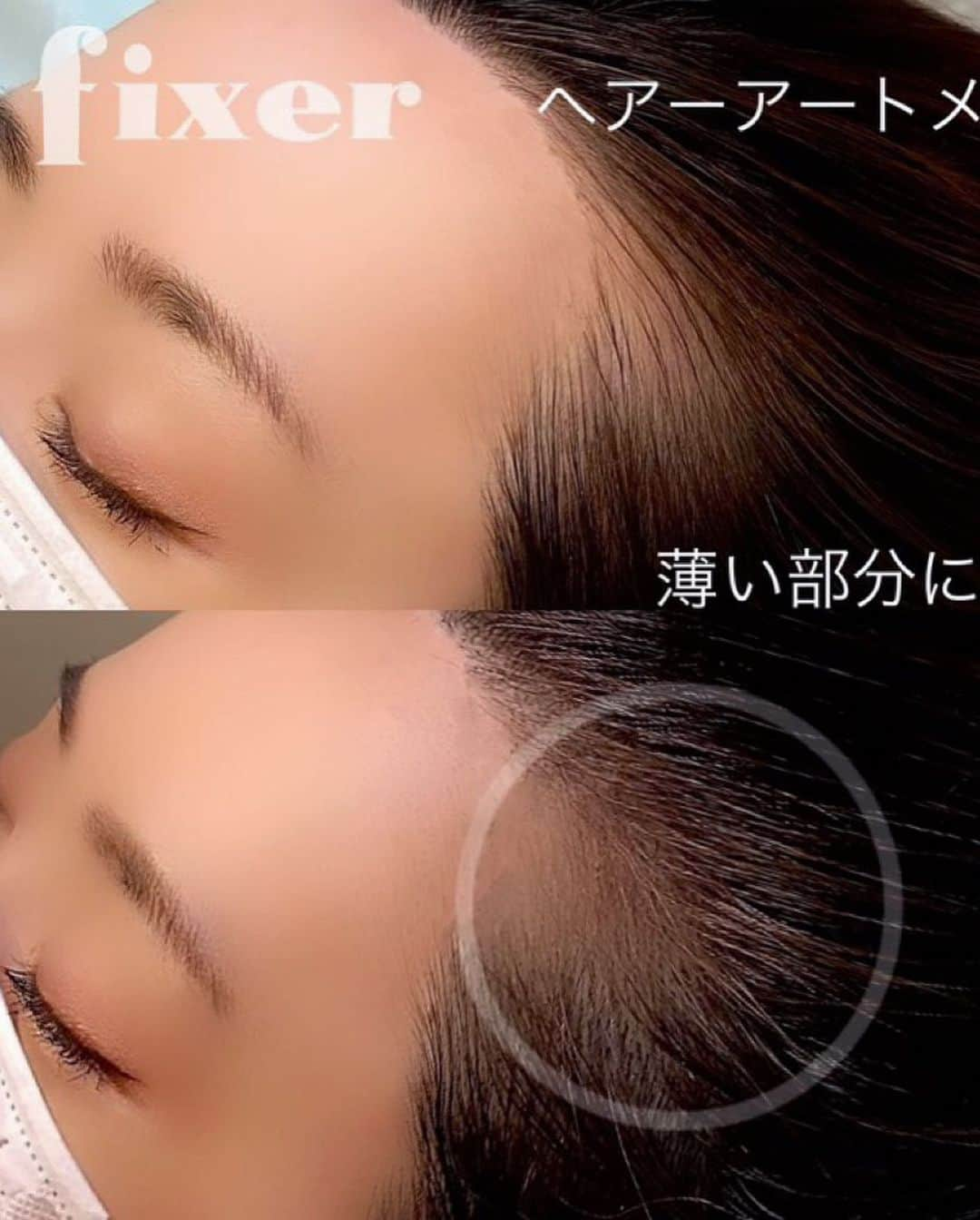 ゆうたむさんのインスタグラム写真 - (ゆうたむInstagram)「VENUS BEAUTY CLINIC 銀座にて  ヘアアートメイクの施術にしてきました😊 @venus_beauty_clinic   全部で3回で仕上がるコースの今回1回目で 1回目は控えめに入れるので今回はまだ仕上がりではないのですが 1回でも薄くなってたところがマシになってきた❣️  おでこのM字ハゲ気にしてたのですが アップヘアのヘアアレンジを避けてしまっていたのですがこれから気にせずできるようになるといいな🥺  fixerというパウダータイプの施術とストロークという毛流れを線で描くタイプの施術があるみたいですがfixerにしていただきました😊  ＠venus_beauty_clinic ＠vb_medical_art @ mochizuki_venusbrows  #venusbeautyclinic  #ヘアアートメイク  #アートメイク #artmakeup  #美容クリニック #美容外科 #アンチエイジング  #ゆうたむの美容メモ📝  #sponsored」9月16日 9時09分 - yuutamu_non