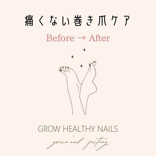 のインスタグラム：「〝お爪は健康のバロメーター〟 巻き爪の改善をしていくことで ライフスタイルの見直しや改善に繋がり  見た目だけではない 本来の健康を取り戻すきっかけにもなっています✨  ほんの少しですが 巻き爪Before→Afterをご紹介させていただきます☺️  カウンセリングは無料です これって巻き爪かな？と 気になる方はお気軽にご相談ください✨  #爪質改善 #育爪ケア #巻き爪ケア   ______________________ 《grace'nail factoryのこだわり》  ✔︎design policy ネイルは一番身近な芸術 お客様の満足、感動、好奇心を満たす、オリジナルアートのクリエイションにつとめております  ✔︎育爪policy お爪本来の力を育つよう 丁寧なケア、爪質改善のためのアプローチを行なっています  ・アセトン不使用（当店オフの場合」 ・フィルイン ・ウォーターケア付き ・お爪周りの角質ケア  お爪の健康を大切にしていきたい方 、爪質改善を求めている方、ジェルネイルの持ちを良くしたい方に 喜ばれています  ✔︎おもてなしpolicy お客様が【ここへ来たら元気になれる】と喜んでいただけるような〝心〟ある空間づくりを大切にしています  ✔︎エシカルへの取り組み 人への影響だけではなく、地球環境に配慮した良質な商材選びにこだわっています  ——  @gracenailfactory   大阪市西区南堀江1-21-9 南堀江ビル2階  ☞堀江公園のすぐそば ☞レンガ色の入り口  定休日/木曜日 平日10:00-18:30（最終受付） 土日祝11:00-18:30（最終受付）  #堀江ネイル　#マグネットネイル大阪 #大阪ネイルサロン #ウォーターケアのあるサロン  #育爪ネイルサロン  #フィルイン大阪 #個性派ネイル大阪 #カジュアルネイル大阪 #南堀江ネイルサロン #堀江ネイル #ニュアンスネイル大阪  #フットネイル大阪 #インクアート大阪  #ミラーネイル #大人カジュアルネイル #ネイリスト採用大阪 #巻き爪ケア大阪 #네일 #泡ネイル #バブルネイル #ネイリスト求人大阪 #秋ネイル #nail」