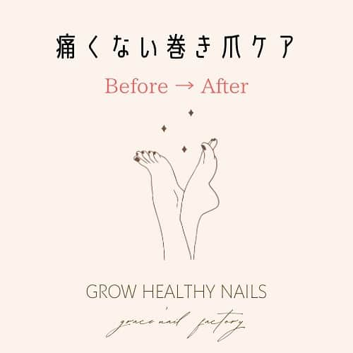 gracenailfactoryのインスタグラム：「〝お爪は健康のバロメーター〟 巻き爪の改善をしていくことで ライフスタイルの見直しや改善に繋がり  見た目だけではない 本来の健康を取り戻すきっかけにもなっています✨  ほんの少しですが 巻き爪Before→Afterをご紹介させていただきます☺️  カウンセリングは無料です これって巻き爪かな？と 気になる方はお気軽にご相談ください✨  #爪質改善 #育爪ケア #巻き爪ケア   ______________________ 《grace'nail factoryのこだわり》  ✔︎design policy ネイルは一番身近な芸術 お客様の満足、感動、好奇心を満たす、オリジナルアートのクリエイションにつとめております  ✔︎育爪policy お爪本来の力を育つよう 丁寧なケア、爪質改善のためのアプローチを行なっています  ・アセトン不使用（当店オフの場合」 ・フィルイン ・ウォーターケア付き ・お爪周りの角質ケア  お爪の健康を大切にしていきたい方 、爪質改善を求めている方、ジェルネイルの持ちを良くしたい方に 喜ばれています  ✔︎おもてなしpolicy お客様が【ここへ来たら元気になれる】と喜んでいただけるような〝心〟ある空間づくりを大切にしています  ✔︎エシカルへの取り組み 人への影響だけではなく、地球環境に配慮した良質な商材選びにこだわっています  ——  @gracenailfactory   大阪市西区南堀江1-21-9 南堀江ビル2階  ☞堀江公園のすぐそば ☞レンガ色の入り口  定休日/木曜日 平日10:00-18:30（最終受付） 土日祝11:00-18:30（最終受付）  #堀江ネイル　#マグネットネイル大阪 #大阪ネイルサロン #ウォーターケアのあるサロン  #育爪ネイルサロン  #フィルイン大阪 #個性派ネイル大阪 #カジュアルネイル大阪 #南堀江ネイルサロン #堀江ネイル #ニュアンスネイル大阪  #フットネイル大阪 #インクアート大阪  #ミラーネイル #大人カジュアルネイル #ネイリスト採用大阪 #巻き爪ケア大阪 #네일 #泡ネイル #バブルネイル #ネイリスト求人大阪 #秋ネイル #nail」