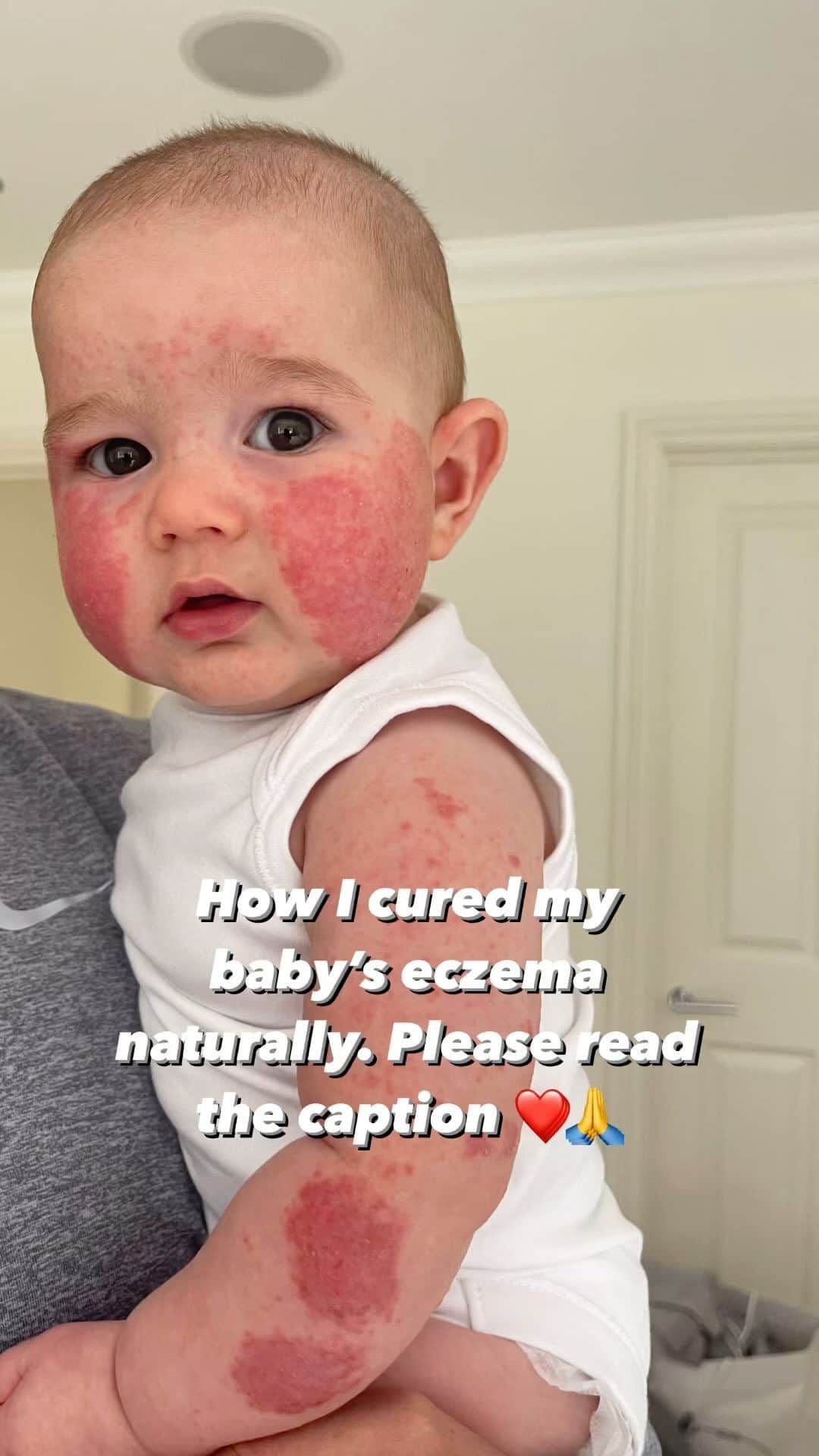 サム・フェアーズのインスタグラム：「⚠️This is not medical advice ⚠️ I’ve wanted to share this with you for so long now. It really does break my heart looking at these images and videos 💔  We healed Edward NATURALLY 🌱 please do not write anything negative, I just really wanted to share with you what we researched and what we done to heal Edward 🙏 It took us a few months to really understand how babies get eczema. It was totally new to us as parents, Paul & Rosie didn’t have it so we really didn’t know what why or how Edward got it so severely 😔  There is a strong link between eczema and the gut and that’s just one piece to the puzzle.. it’s a case of vitamin & mineral deficiency too, which was a shock to me as I was exclusively breastfeeding Edward. We had to make many changes to our diet.  -We mainly eliminated eggs, milk, wheat, gluten, refined sugar & no processed foods. -We eat lots of grass fed lamb and meat.  -ONLY use coconut oil when cooking (we use a flavourless organic one from Amazon)  -SUNSHINE ☀️ this was the most noticeable highlight for us in the process. Every chance we had when the sun was out we would put him in it. -Shilajit (drops in with water)  -liquid vitamin D was great and easy to give Edward -Water, we added ION gut for kids to every drink he had -Bath in Epsom salts, apple cider vinegar & clay. Small amounts of each a few times a week -I was taking intracellular sea moss capsules & a Plant calcium with vitamin D3, K2, and C.  -I also got a red light from Amazon and would occasionally hold it over him whilst he was playing or eating.  -We used pure organic tallow balm to stop the itching from @fiercenatureuk  3/4 months and it cleared up 🙏 It wasn’t easy, but look at him now ❤️  We have now introduced all foods and he is eating practically everything (in moderation).  I hope this helps anyone who has a baby with eczema. You’re not alone. ❤️ I couldn’t have done this without the advice from @catherine_farrant and my fantastic herbalist @mypronatural for supplying me with all the bits we needed 🙏 Also a shout-out to @iamelliegrey for Edwards hair mineral analysis.」