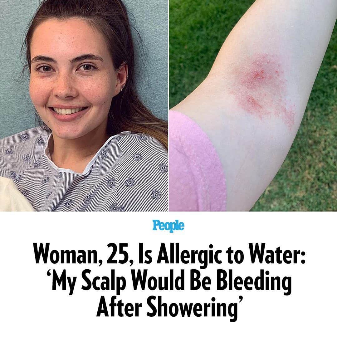 People Magazineさんのインスタグラム写真 - (People MagazineInstagram)「A 25-year-old woman from Fresno is allergic to water, a rare condition that causes her to break out in welts and hives — even from her own tears and sweat — and that affects only about 250 people worldwide. "I would come out of showers and have huge welts on my skin,” Tessa Hansen-Smith said about her allergy, which she developed when she was 8 years old. “I’ve cleaned my body with wet towelettes designed for it here and there, but even then those hurt.” For more on Tessa's life, including how she stays hydrated and the bullying she's endured due to her condition, head to the link in bio. | 📷: Tessa Living Waterless/Instagram」10月5日 2時46分 - people