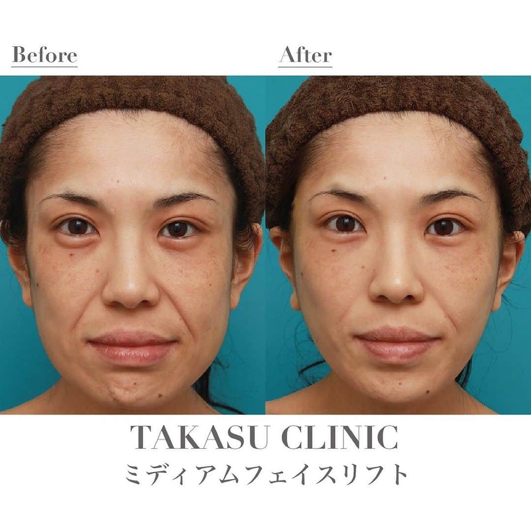 高須クリニック名古屋院のインスタグラム：「#repost @takasumikiya via @PhotoAroundApp  ミディアムフェイスリフトで頬のたるみを改善し、法令線が浅くなった30代女性の症例写真  施術方法 ミディアムフェイスリフト  30代女性の患者様で、頬のたるみ、フェイスラインの乱れ、はっきりと深く刻まれた法令線などを気にされていました。 診察させていただいたところ、年齢相応に顔全体の肌の張りがなくなってきており、特に頬がたるんでいました。 痩せているため、皮膚の張りがなく、法令線が目立っていました。 患者様は切ることには抵抗ないので、なるべくしっかりとたるみをリフトアップし、エイジングケアしたいというご要望でしたので、ミディアムフェイスリフトをすることになりました。 手術は、こめかみの頭髪内から耳前部、耳の少し後ろまで皮膚を切開し、皮下でリテイニングリガメントを外した後、余分なSMAS（スマス）を切除して、表情筋膜を引き上げ固定しました。 術後は綺麗に顔の下半分がリフトアップされ、フェイスラインがすっきりしました。 また、頬のたるみが改善したことにより、法令線が少し浅くなりました。 この患者様のように、痩せていて皮膚が薄く、骨格的にシャープな輪郭をしている人は、リフトアップ手術をすることにより、法令線が浅くなって目立たなくなることがあります。 ただし、皮膚の厚い人、顔に肉厚がある人、骨格的に頬骨やエラが発達している人、大きな丸顔の人などは、リフトアップ手術をしても、法令線の上部にある皮膚や脂肪のたるみまで引き上げる力が伝わらず、フェイスラインのたるみは改善しても、法令線はあまり改善しないことがあります。  【施術料金】 ミディアムフェイスリフト ¥990,000（税込）  【銀座高須クリニック 、横浜 、名古屋 、大阪 】  【リスク・副作用・合併症】 ミディアムフェイスリフト 切開した周辺の腫れ（術後） 仕上がりのわずかな左右差（完璧なシンメトリーは不可）  傷跡が肥厚性瘢痕やケロイドになる可能性  感覚が鈍くなる可能性  手術後の血腫  【ご予約・お問い合わせ】 名古屋院☎︎ 052-564-1187 名古屋院📱 @takasuclinic_nagoya ↑名古屋院インスタのプロフィール画面からも直接コンタクトが取れます📲 https://www.takasu.co.jp/  #高須クリニック #高須クリニック名古屋院 #高須幹弥 #高須英津子 #美容整形 #整形 #二重 #埋没法 #二重切開 #ヒアルロン酸 #鼻 #ニキビ #豊胸 #たるみ #しみ #シワ #ほうれい線 #毛穴 #目 #整形したい #美容好きな人と繋がりたい #可愛くなりたい #綺麗になりたい #平行二重 #末広二重 #プチ整形 #フェイスリフト #ミディアムフェイスリフト #ビフォーアフター」