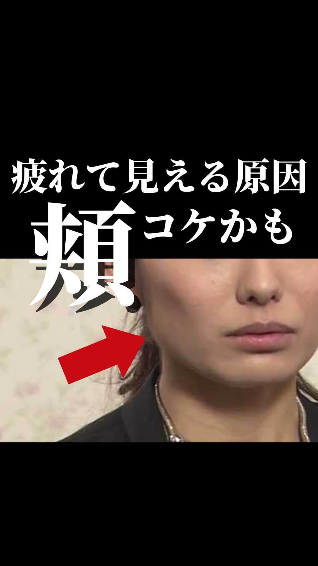 恵比寿フィラークリニックのインスタグラム：「頬がげっそりとしてしまうと、、、 💔疲れた印象 💔老けて見える 💔面長が協調される など、マイナスな印象になってしまいます💧  これらを改善するのが「ムンクフィラー😱」(頬こけヒアルロン酸注入) 頬のコケた部分にヒアルロン酸を注入する事で ふっくらとした若々しい印象に改善されます✨  若い方でも頬にボリュームが無いと、どこか疲れた印象になってしまうのでムンクフィラーはおすすめです💓  [料金] 0.1㏄　¥3,300 (税込 ¥3,630)～  #頬こけ #頬コケ #頬ヒアルロン酸 #疲れ顔 #老け顔 #老け見え #老けたくない #アンチエイジング #エイジングケア #美容 #美容好き」