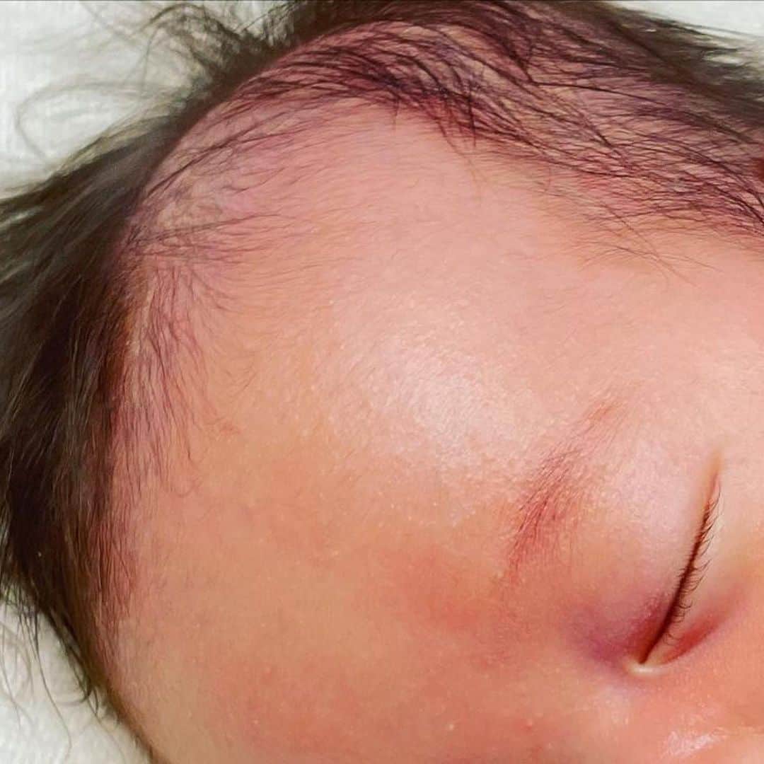 Fam's Baby ファムズベビーさんのインスタグラム写真 - (Fam's Baby ファムズベビーInstagram)「ホルモンの影響によって皮脂分泌が活発になって起こる乳児湿疹 ⁡ 乳児湿疹の原因は過剰な皮脂分泌です。 赤ちゃんはママのおなかにいたときのホルモンの影響で皮脂の分泌が盛んなので 毛穴が詰まりやすく、皮脂腺に脂がたまりやすいのです🥲 ⁡ 「皮脂が多いのに保湿？」と 思うかもしれませんが 肌を正常な状態に戻すことで 過剰な皮脂分泌を抑えることが目的です。 ⁡ 清潔なお肌にぬってあげてくださいね♪ ⁡ ⁡ photo by @ebipilaf_11 様 素敵なご投稿ありがとうございます✨ ※掲載の許可をいただいております ⁡ _____________________________ ⁡ ※2.3.枚目閲覧注意⚠️ 肌荒れ写真あります。 ⁡ 天使の羽👼🏻　 乳児湿疹で悩み続けて 何をしても何を使ってもよくならず… でステロイドは使いたくなくて… そんなときにファムズベビーに出会って。 3日で良くなったお肌。 乳児湿疹が出てる時は触ることも躊躇ってたけど 綺麗なお肌になってからはすりすりできて本当にうれしい🥚 我が家はビックボトルを購入して愛用してます ありがとうファムズベビー。 _____________________________ ⁡ ☁️エンジェルフォーム☁️ 内容量85g 2640円（税込） ------------------- 肌トラブル予防や育児・子育て情報発信👶🏻🍼 ママの心配事や疑問を解消する投稿を発信してます♪ @famsbaby 👈プロフィールからチェック♪ ------------------- ⁡ ⏬check 👶🏻赤ちゃんの成長を無料オンラインサポート 【ファムズのがっこう】毎週開校中🏫 Instagramトップリンクから公式サイトへ♪ ⁡ ☁️泡あわアートキャンペーンを毎月実施中☁️ エンジェルフォームでアワアワになって可愛く楽しくスキンケアしよう☁️🤍 #泡あわアートキャンペーン #赤ちゃんのスキンケア #ファムズベビー をつけて投稿してください♪ 毎月10名様にお好きな商品をプレゼントしております🎁 ⁡ #ベビースキンケア#ベビースキンケア用品#赤ちゃんの保湿#赤ちゃんの肌トラブル#赤ちゃんスキンケア#ベビーケア#赤ちゃん保湿#赤ちゃん用品#エンジェルフォーム#乳児湿疹ひどい#乳児湿疹対策#乳児湿疹治った#乳児肌荒れ」9月23日 18時41分 - famsbaby