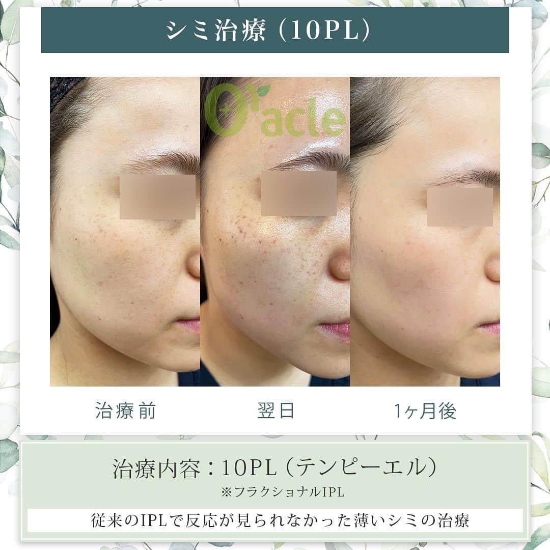 オラクル美容皮膚科東京新宿院のインスタグラム：「◤そばかす治療◢| 《治療内容》10PL 1回目 他のレーザー、IPLでは取りきれなかった 薄いシミ（そばかす）に反応し改善が見られます  ☑️10PL 韓国Oracle統括院長　ノ・ヨンウ医師開発 世界初の技術『フラクショナルIPL』搭載 ➡︎特許取得  安全性 ・韓国MFDS承認機器 ・アメリカFDA承認機器  治療目的：シミそばかすの除去、肌の再生  【ダウンタイム】 赤み：3〜5日 瘡蓋：7〜10日　※テープ保護不要 洗顔：当日 メイク：当日から可能ですが、ひりつきが出ますので翌日から推奨 ⁡ 【料金】 1回38,500円税込（鎮静管理込み）  ※目周りを除く  🉐初回セット 初回セット35,000円税込（鎮静管理込み） オプション：目周り8,800円 ⁡ #シミ #シミ取り　#シミ治療 #シミ取りレーザー #そばかす #10pl #フラクショナルレーザー #IPL #IPLレーザー #美肌　#美白 #美容皮膚科 #韓国美容　#韓国好きな人と繋がりたい #韓国クリニック」