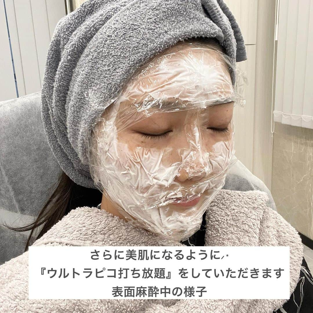 橘珠里さんのインスタグラム写真 - (橘珠里Instagram)「⋆ 𝗧𝗛𝗘 𝗥𝗢𝗣𝗣𝗢𝗡𝗚𝗜 𝗖𝗟𝗜𝗡𝗜𝗖 ⋆  シミ・ソバカスで悩んでいたお肌  ザロク 恵比寿院 院長の長尾 沙也加 先生( @dr.sayakanagao )に相談をしたのをきっかけに、嬉しいことに、どんどん美肌になっています…🥹  同じ悩みを持つ方の参考になれば嬉しいなと思い、ダウンタイムや変化の様子をまとめたので、是非見てみてください⭐︎   以前お願いした初めてのピコトーニングで、すでにかなりのシミ・ソバカスが薄くなり、感動だったのですが、今回さらに『ウルトラピコ打ち放題』をしていただき、より理想のお肌に近づきました⋆͛  シミだけでなく、お肌全体がトーンアップし、状態も良くなり、お化粧のりもよく、ものすごく幸せです🥲♡  施術後のダウンタイムは少しシミが濃くなる時があるのですが、それを過ぎれば薄くなっていくと聞いていたので、安心して待っていたら、その通りでした♪  自分の目標に向けて、今は人生で一番きれいなお肌になりたいのですが、さやか先生のおかげで”本当にそうなれるんだ!”と願望が現実になっていることに、とにかく感謝です✨  私のように、悩んでいても何をしたら良いのか分からない…という方にも安心の、おすすめ過ぎるクリニックさんです☺️  @the_roppongi_clinic  #theroppongiclinic #ザロッポンギクリニック #ザロク #ウルトラピコ打ち放題 #オーダーメイド治療 #自分史上最高の美 #ピコスポット #ピコトーニング #ピコフラクショナル #ピコレーザー  #美肌 #美肌ケア #シミケア #シミ取り #トーンアップ #ダウンタイム」9月25日 0時04分 - jurinu