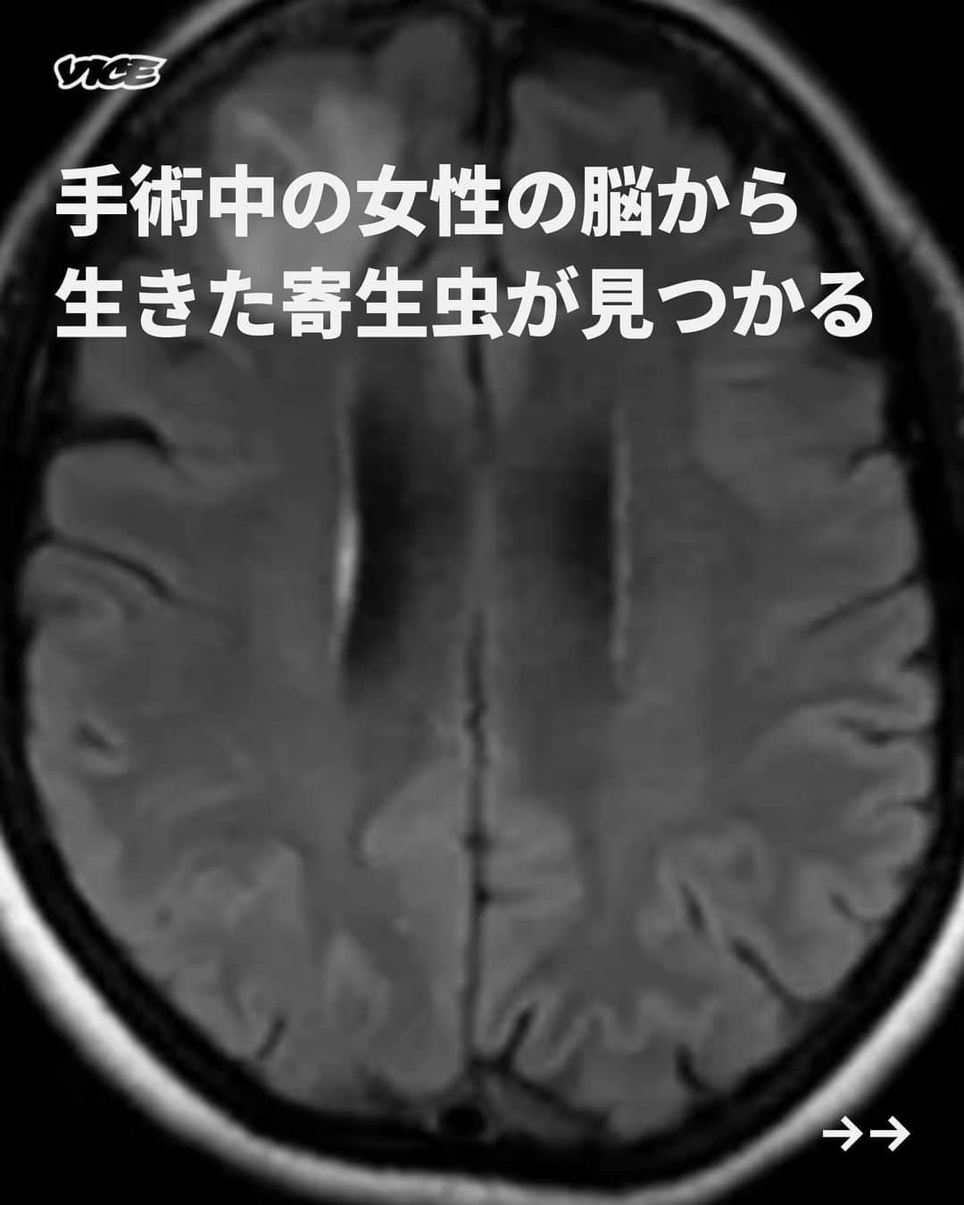 VICE Japanのインスタグラム：「64歳のオーストラリア人女性の脳から、体長8センチの生きた線虫が見つかった。これまでに前例のない感染だ。  このオピダスカリス・ロベルティと呼ばれる寄生虫は、手術中に女性の前頭葉から摘出され、最長で2ヶ月間、脳内にいた可能性があるという。オーストラリアの神経外科医たちは、患者の脳から生きた虫を発見して衝撃を受けた。  記事詳細は @vicejapan プロフィールのリンクから  #vicejapan #vice #ヴァイスジャパン」