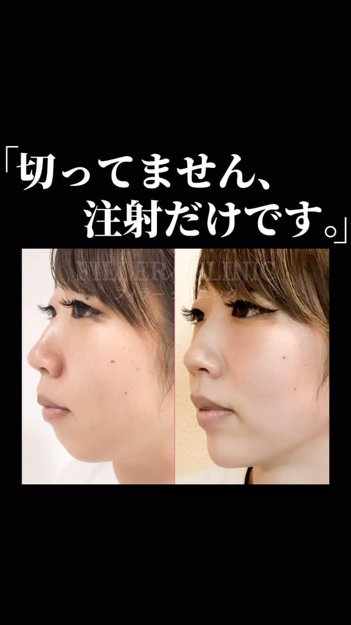 のインスタグラム：「切らずに整形？ 注射だけでこんなに変わる✨  💜鼻ヒアルロン酸 ヒアルロン酸を注入する事で立体感が増し、 さらに、目が近づいて見え、離れ目が気になる方にもぴったり💓  💜顎ヒアルロン酸 顎ヒアルロン酸注入で顎を少し前に出すことで、、、🥰 ♡横顔のラインが綺麗になる✨ ♡モデルのようなシュッとした顎先になる✨ 口元が吐出して見える「口ゴボ」でお悩みの方にもおすすめです！  💜エラボト エラにボツリヌストキシンを注入する事で エラの筋肉の働きを抑制し、自然に痩せたような小顔効果があります✨ また、歯ぎしり・食いしばり防止にも効果的です😊  [料金] キツネVライン S　 ¥65,000 (税込¥71,500) M　¥120,000 (税込¥132,000) L　 ¥180,000 (税込¥198,000) 麻酔代・カニューレ代込みだからセットがお🉐」