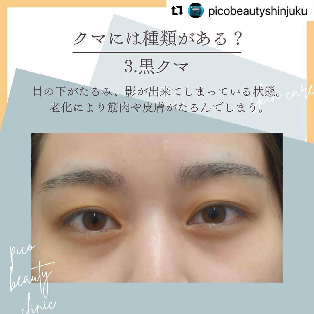 YAG BEAUTY CLINICさんのインスタグラム写真 - (YAG BEAUTY CLINICInstagram)「#Repost @picobeautyshinjuku with @use.repost ・・・ 『若い』は作れます！目の下のクマ&たるみについてご紹介しています💁‍♀️  ✅顔が疲れて見える ✅老けて見える ✅目の下がぽこっとしてる ✅コンシーラーで隠れない ✅目元や表情の暗い印象 ✅一度で自然な若返りをしたい ✅目元すっきりしたい などなど様々なお悩みに💁‍♀️  ご予約・お問い合わせにつきましては当院までお電話お待ち致しております🙇‍♀️ 💎PICO BEAUTY CLINIC💎 〒160-0022 東京都新宿区新宿3-29-17新盛堂ビル8階 📲0120-900-253  #美容クリニック #美容外科 #美容皮膚科 #美容看護師 #picobeautyclinic #ピコビューティークリニック #ピコレーザー #新宿東口 #新宿 #ピコシュア #ピコトーニング #ピコフラクショナル#ピコスポット #シミ取り #シミ取り放題 #ピコシュアならピコビューティークリニック  #肌育  #アンチエイジング　#スキンケア #美白ケア #ダウンタイム #若返り #肌治療 #肌質改善 #たるみ取り #脂肪取り #症例写真 #下眼瞼脱脂 #クマ取り  @yagbeauty_official」10月29日 14時27分 - yagbeauty_official