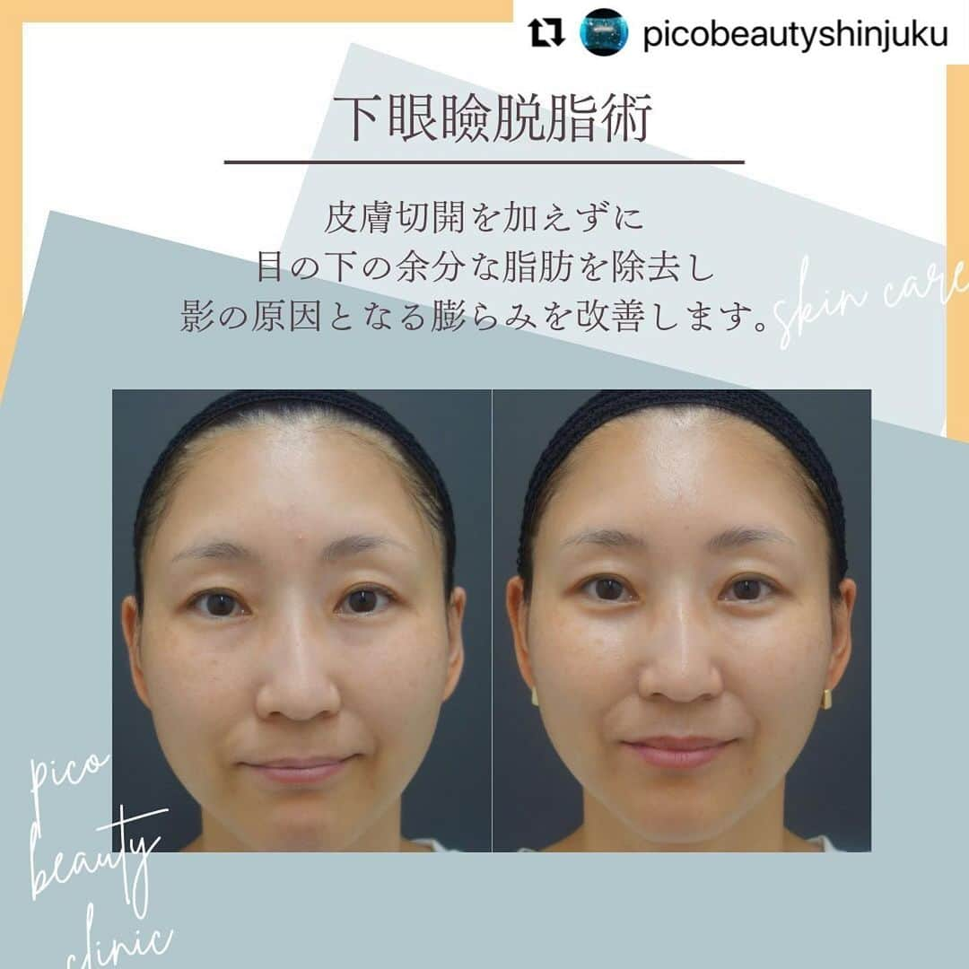 YAG BEAUTY CLINICさんのインスタグラム写真 - (YAG BEAUTY CLINICInstagram)「#Repost @picobeautyshinjuku with @use.repost ・・・ 『若い』は作れます！目の下のクマ&たるみについてご紹介しています💁‍♀️  ✅顔が疲れて見える ✅老けて見える ✅目の下がぽこっとしてる ✅コンシーラーで隠れない ✅目元や表情の暗い印象 ✅一度で自然な若返りをしたい ✅目元すっきりしたい などなど様々なお悩みに💁‍♀️  ご予約・お問い合わせにつきましては当院までお電話お待ち致しております🙇‍♀️ 💎PICO BEAUTY CLINIC💎 〒160-0022 東京都新宿区新宿3-29-17新盛堂ビル8階 📲0120-900-253  #美容クリニック #美容外科 #美容皮膚科 #美容看護師 #picobeautyclinic #ピコビューティークリニック #ピコレーザー #新宿東口 #新宿 #ピコシュア #ピコトーニング #ピコフラクショナル#ピコスポット #シミ取り #シミ取り放題 #ピコシュアならピコビューティークリニック  #肌育  #アンチエイジング　#スキンケア #美白ケア #ダウンタイム #若返り #肌治療 #肌質改善 #たるみ取り #脂肪取り #症例写真 #下眼瞼脱脂 #クマ取り  @yagbeauty_official」10月29日 14時27分 - yagbeauty_official