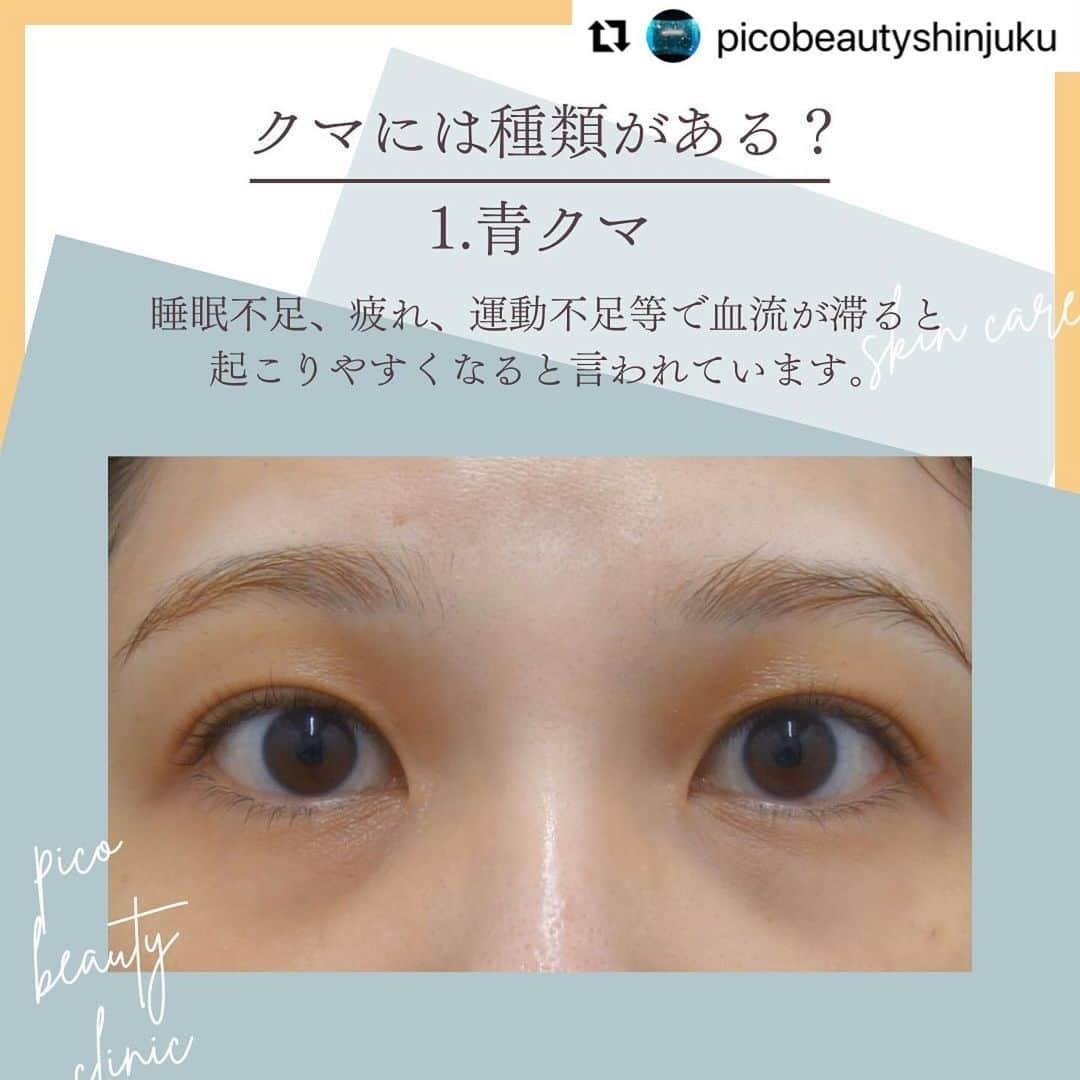 YAG BEAUTY CLINICさんのインスタグラム写真 - (YAG BEAUTY CLINICInstagram)「#Repost @picobeautyshinjuku with @use.repost ・・・ 『若い』は作れます！目の下のクマ&たるみについてご紹介しています💁‍♀️  ✅顔が疲れて見える ✅老けて見える ✅目の下がぽこっとしてる ✅コンシーラーで隠れない ✅目元や表情の暗い印象 ✅一度で自然な若返りをしたい ✅目元すっきりしたい などなど様々なお悩みに💁‍♀️  ご予約・お問い合わせにつきましては当院までお電話お待ち致しております🙇‍♀️ 💎PICO BEAUTY CLINIC💎 〒160-0022 東京都新宿区新宿3-29-17新盛堂ビル8階 📲0120-900-253  #美容クリニック #美容外科 #美容皮膚科 #美容看護師 #picobeautyclinic #ピコビューティークリニック #ピコレーザー #新宿東口 #新宿 #ピコシュア #ピコトーニング #ピコフラクショナル#ピコスポット #シミ取り #シミ取り放題 #ピコシュアならピコビューティークリニック  #肌育  #アンチエイジング　#スキンケア #美白ケア #ダウンタイム #若返り #肌治療 #肌質改善 #たるみ取り #脂肪取り #症例写真 #下眼瞼脱脂 #クマ取り  @yagbeauty_official」10月29日 14時27分 - yagbeauty_official