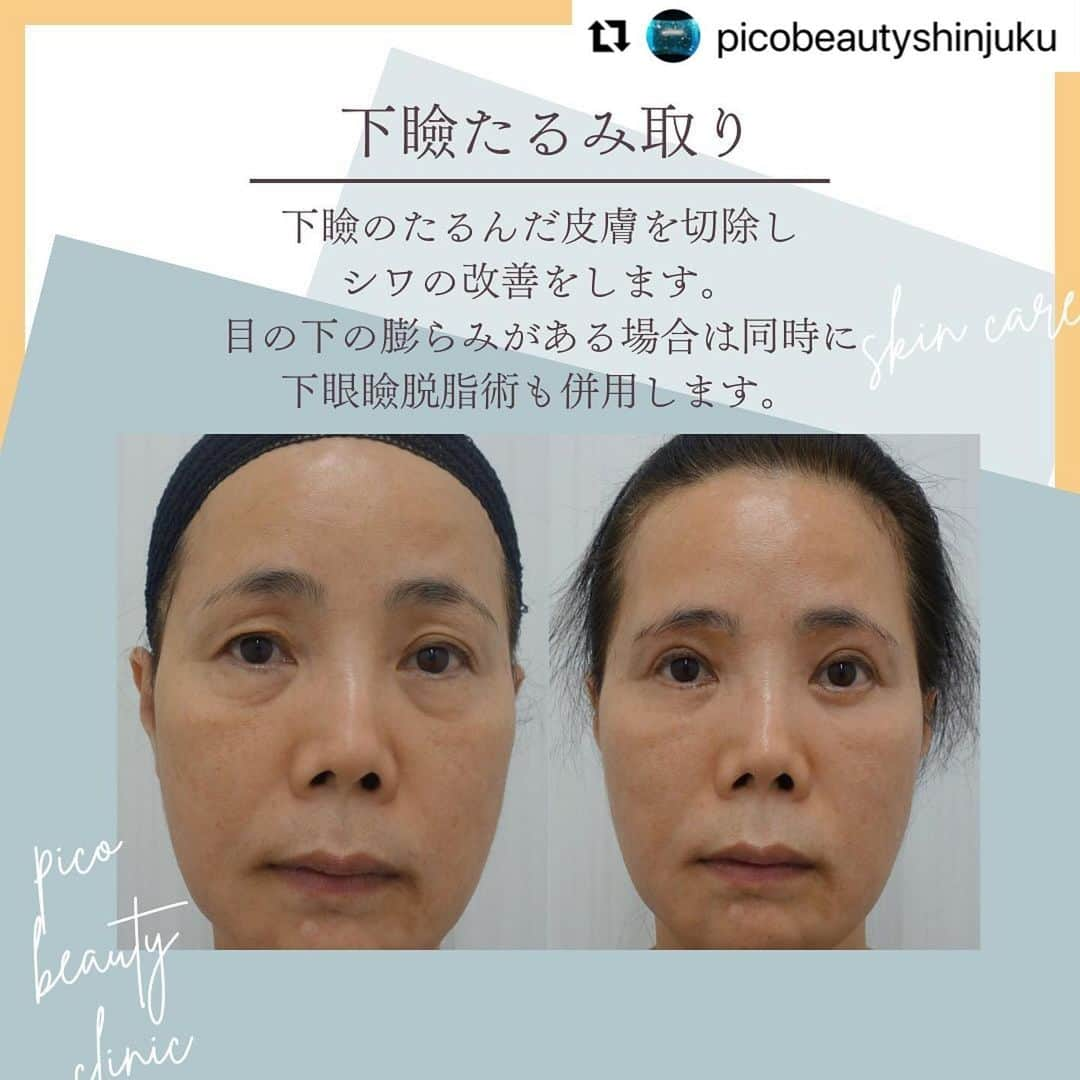 YAG BEAUTY CLINICさんのインスタグラム写真 - (YAG BEAUTY CLINICInstagram)「#Repost @picobeautyshinjuku with @use.repost ・・・ 『若い』は作れます！目の下のクマ&たるみについてご紹介しています💁‍♀️  ✅顔が疲れて見える ✅老けて見える ✅目の下がぽこっとしてる ✅コンシーラーで隠れない ✅目元や表情の暗い印象 ✅一度で自然な若返りをしたい ✅目元すっきりしたい などなど様々なお悩みに💁‍♀️  ご予約・お問い合わせにつきましては当院までお電話お待ち致しております🙇‍♀️ 💎PICO BEAUTY CLINIC💎 〒160-0022 東京都新宿区新宿3-29-17新盛堂ビル8階 📲0120-900-253  #美容クリニック #美容外科 #美容皮膚科 #美容看護師 #picobeautyclinic #ピコビューティークリニック #ピコレーザー #新宿東口 #新宿 #ピコシュア #ピコトーニング #ピコフラクショナル#ピコスポット #シミ取り #シミ取り放題 #ピコシュアならピコビューティークリニック  #肌育  #アンチエイジング　#スキンケア #美白ケア #ダウンタイム #若返り #肌治療 #肌質改善 #たるみ取り #脂肪取り #症例写真 #下眼瞼脱脂 #クマ取り  @yagbeauty_official」10月29日 14時27分 - yagbeauty_official