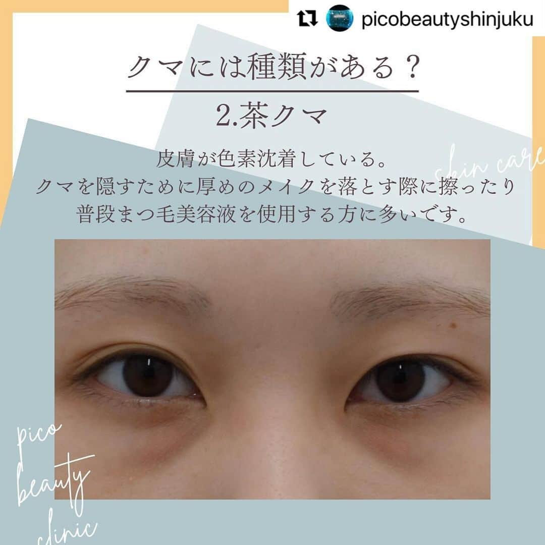 YAG BEAUTY CLINICさんのインスタグラム写真 - (YAG BEAUTY CLINICInstagram)「#Repost @picobeautyshinjuku with @use.repost ・・・ 『若い』は作れます！目の下のクマ&たるみについてご紹介しています💁‍♀️  ✅顔が疲れて見える ✅老けて見える ✅目の下がぽこっとしてる ✅コンシーラーで隠れない ✅目元や表情の暗い印象 ✅一度で自然な若返りをしたい ✅目元すっきりしたい などなど様々なお悩みに💁‍♀️  ご予約・お問い合わせにつきましては当院までお電話お待ち致しております🙇‍♀️ 💎PICO BEAUTY CLINIC💎 〒160-0022 東京都新宿区新宿3-29-17新盛堂ビル8階 📲0120-900-253  #美容クリニック #美容外科 #美容皮膚科 #美容看護師 #picobeautyclinic #ピコビューティークリニック #ピコレーザー #新宿東口 #新宿 #ピコシュア #ピコトーニング #ピコフラクショナル#ピコスポット #シミ取り #シミ取り放題 #ピコシュアならピコビューティークリニック  #肌育  #アンチエイジング　#スキンケア #美白ケア #ダウンタイム #若返り #肌治療 #肌質改善 #たるみ取り #脂肪取り #症例写真 #下眼瞼脱脂 #クマ取り  @yagbeauty_official」10月29日 14時27分 - yagbeauty_official