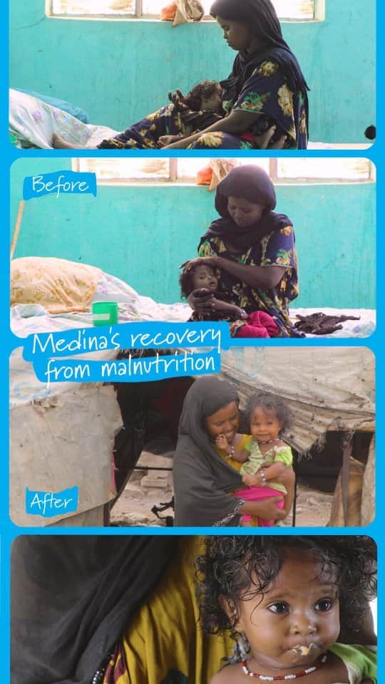 unicefのインスタグラム：「Baby Medina in Ethiopia was so malnourished her mother was worried she wouldn’t make it.  This is how a special milk and paste provided by UNICEF helped her recover.」