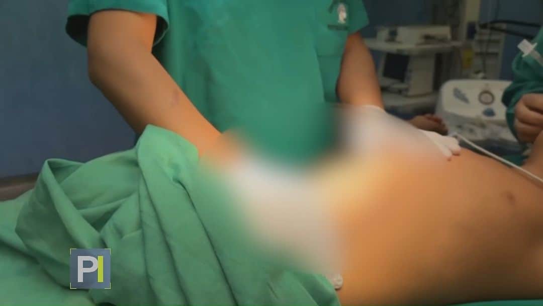 Primer Impactoのインスタグラム：「📌 Con un arpón clavado en su estómago durante más de 12 horas, un niño llega a un hospital para ser operado de emergencia.  📺 Más en #PrimerImpacto a las 5pm/ 4C por @univision」