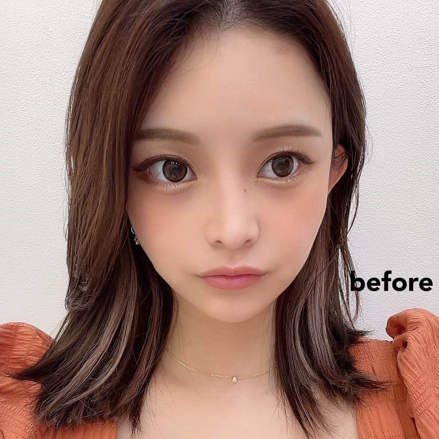 sayaさんのインスタグラム写真 - (sayaInstagram)「A clinic新宿院 @aclinic_shinjuku  の吉川彩先生  @aclinic_yoshikawa  に“1day小顔脂肪吸引”を施術していただいた経過✨  当日は麻酔が効いてて痛みはありませんでした！ ２日目からつっぱった感じはあったけど痛み止めもいただいていたので気にならない程度でした🫶 1週間経ってからはアザもなくなってフェイスライもスッキリ🥹✨ 気になってた部分だから凄く嬉しい🫶💓 フェイスラインのたるみを無くしたい方オススメです✨  前回のスマイルリップもまたやりたいなぁ🫶  #aclinic #aクリニック #エークリニック #aclinic銀座 #aclinic横浜 #aclinic新宿  #aclinic名古屋 #aclinic大阪 #aclinic福岡 #aclinic池袋  #aclinic仙台 #美容外科 #美容皮膚科  #1day小顔脂肪吸引 #1day小顔 #脂肪吸引 #小顔 #美肌 #二重あご #フェイスライン  #糸リフト #aスレッド #顔痩せ #部分やせ #小顔整形 #小顔になりたい #横顔美人 #吉川彩」10月26日 21時06分 - chacha_maru425