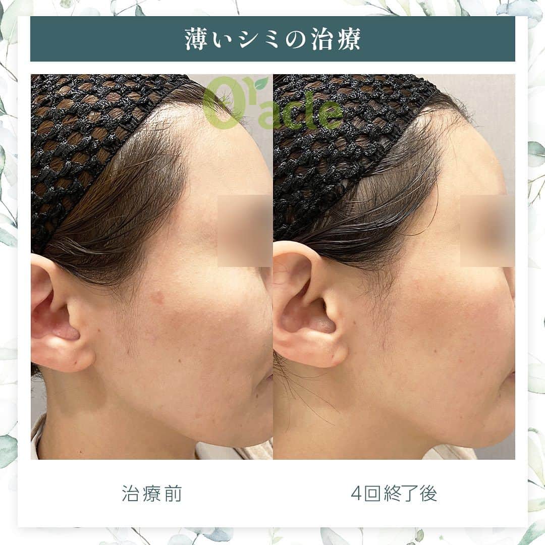 オラクル美容皮膚科東京新宿院さんのインスタグラム写真 - (オラクル美容皮膚科東京新宿院Instagram)「◤薄いシミの治療◢| 《治療内容》10PL 4回目 以前にも投稿した方ですが新たに4回目を行い、ほぼ分からない位になりました。 他のレーザー、IPLでは全く反省せず、10PLは3回で薄くはなったもののまだ気になるとのことで4回治療。 薄いシミに反応し改善が見られます。  ☑️10PL 韓国Oracle統括院長　ノ・ヨンウ医師開発 世界初の技術『フラクショナルIPL』搭載 ➡︎特許取得  安全性 ・韓国MFDS承認機器 ・アメリカFDA承認機器  治療目的：シミそばかすの除去、肌の再生  【ダウンタイム】 赤み：3〜5日 瘡蓋：7〜10日　※テープ保護不要 洗顔：当日 メイク：当日から可能ですが、ひりつきが出ますので翌日から推奨 ⁡ 【料金】 1回38,500円税込（鎮静管理込み）  ※目周りを除く  🉐初回セット 初回セット35,000円税込（鎮静管理込み） オプション：目周り8,800円 ⁡ #シミ　#薄いシミ  #シミ取り　#シミ治療 #シミ取りレーザー #そばかす #10pl #フラクショナルレーザー #IPL #IPLレーザー #美肌　#美白 #美容皮膚科 #韓国美容　#韓国好きな人と繋がりたい #韓国クリニック」10月27日 18時17分 - oraclejp