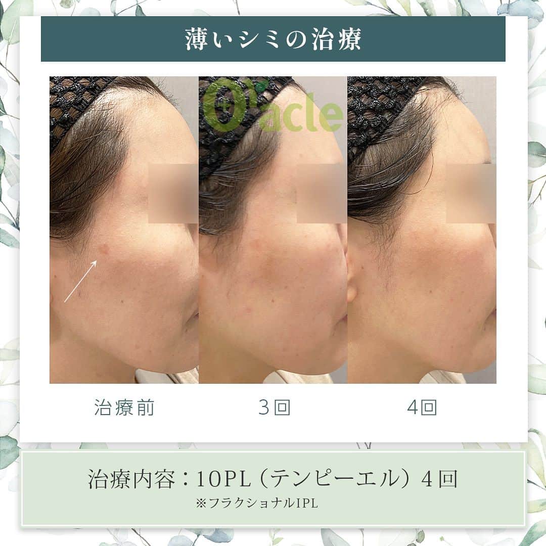 オラクル美容皮膚科東京新宿院さんのインスタグラム写真 - (オラクル美容皮膚科東京新宿院Instagram)「◤薄いシミの治療◢| 《治療内容》10PL 4回目 以前にも投稿した方ですが新たに4回目を行い、ほぼ分からない位になりました。 他のレーザー、IPLでは全く反省せず、10PLは3回で薄くはなったもののまだ気になるとのことで4回治療。 薄いシミに反応し改善が見られます。  ☑️10PL 韓国Oracle統括院長　ノ・ヨンウ医師開発 世界初の技術『フラクショナルIPL』搭載 ➡︎特許取得  安全性 ・韓国MFDS承認機器 ・アメリカFDA承認機器  治療目的：シミそばかすの除去、肌の再生  【ダウンタイム】 赤み：3〜5日 瘡蓋：7〜10日　※テープ保護不要 洗顔：当日 メイク：当日から可能ですが、ひりつきが出ますので翌日から推奨 ⁡ 【料金】 1回38,500円税込（鎮静管理込み）  ※目周りを除く  🉐初回セット 初回セット35,000円税込（鎮静管理込み） オプション：目周り8,800円 ⁡ #シミ　#薄いシミ  #シミ取り　#シミ治療 #シミ取りレーザー #そばかす #10pl #フラクショナルレーザー #IPL #IPLレーザー #美肌　#美白 #美容皮膚科 #韓国美容　#韓国好きな人と繋がりたい #韓国クリニック」10月27日 18時17分 - oraclejp