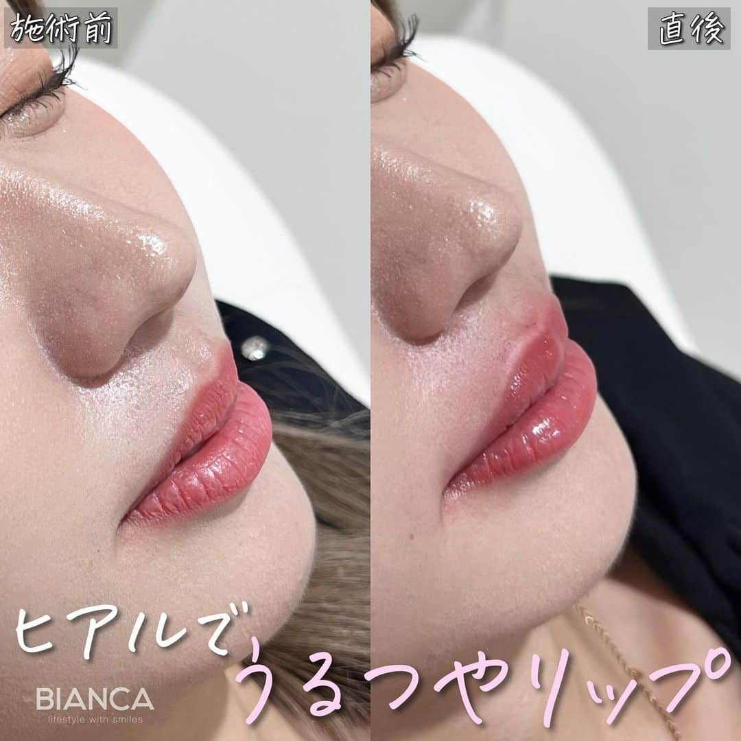 辻沢由有（BIANCA CLNIC 表参道院 院長）のインスタグラム：「#dryuuヒアル  唇ヒアルロン酸でキュートなリップに❤️ 治療時間、約10分👏 ヒアルロン酸でここまで変えられます✨  どうなりたいかわからない方も こだわりがたくさんある方も 綺麗になりたい方、お任せください🥰  ✽.｡.:*・ﾟ ✽.｡.:*・ﾟ ✽.｡.:*・ﾟ ✽.｡.:*・ﾟ ✽.｡.:*・ﾟ  ✔︎唇ヒアルロン酸 Juvederm VOLBELLA 1ml  77,000円＋税 別途施術料　22,000円＋税  ⏳治療時間: 10分 🗓持続期間: 1〜2年 😷腫れ・内出血: 数日程度 ⚠️リスク: 感染・血流障害・凹凸など  ✽.｡.:*・ﾟ ✽.｡.:*・ﾟ ✽.｡.:*・ﾟ ✽.｡.:*・ﾟ ✽.｡.:*・ﾟ  📝ご予約はwebが便利です✨ プロフィール欄のリンクからご予約ください。 ※医師指名可能（“大久保医師指名”をクリック） ※診察料はかかりません🙅‍♀️ ※表参道院勤務が9割となっています。  📍BIANCA CLINIC ※お電話頂くと自動音声通話に繋がります。 ✔︎表参道院 ☎️05018071593 東京都港区南青山5-11-10  南青山511ビル 2F ✔︎銀座院 ☎️05031964834 東京都中央区銀座1-8-19 キラリトギンザ12F  •診療時間 10:00〜19:00 •年中無休（年末年始を除く）   ✽.｡.:*・ﾟ ✽.｡.:*・ﾟ ✽.｡.:*・ﾟ ✽.｡.:*・ﾟ ✽.｡.:*・ﾟ  #唇ヒアルロン酸  #eライン #横顔美人 リップヒアルロン酸#ヒアルロン酸」