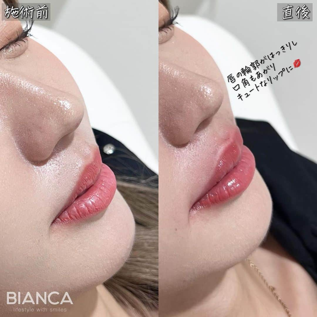 辻沢由有（BIANCA CLNIC 表参道院 院長）さんのインスタグラム写真 - (辻沢由有（BIANCA CLNIC 表参道院 院長）Instagram)「#dryuuヒアル  唇ヒアルロン酸でキュートなリップに❤️ 治療時間、約10分👏 ヒアルロン酸でここまで変えられます✨  どうなりたいかわからない方も こだわりがたくさんある方も 綺麗になりたい方、お任せください🥰  ✽.｡.:*・ﾟ ✽.｡.:*・ﾟ ✽.｡.:*・ﾟ ✽.｡.:*・ﾟ ✽.｡.:*・ﾟ  ✔︎唇ヒアルロン酸 Juvederm VOLBELLA 1ml  77,000円＋税 別途施術料　22,000円＋税  ⏳治療時間: 10分 🗓持続期間: 1〜2年 😷腫れ・内出血: 数日程度 ⚠️リスク: 感染・血流障害・凹凸など  ✽.｡.:*・ﾟ ✽.｡.:*・ﾟ ✽.｡.:*・ﾟ ✽.｡.:*・ﾟ ✽.｡.:*・ﾟ  📝ご予約はwebが便利です✨ プロフィール欄のリンクからご予約ください。 ※医師指名可能（“大久保医師指名”をクリック） ※診察料はかかりません🙅‍♀️ ※表参道院勤務が9割となっています。  📍BIANCA CLINIC ※お電話頂くと自動音声通話に繋がります。 ✔︎表参道院 ☎️05018071593 東京都港区南青山5-11-10  南青山511ビル 2F ✔︎銀座院 ☎️05031964834 東京都中央区銀座1-8-19 キラリトギンザ12F  •診療時間 10:00〜19:00 •年中無休（年末年始を除く）   ✽.｡.:*・ﾟ ✽.｡.:*・ﾟ ✽.｡.:*・ﾟ ✽.｡.:*・ﾟ ✽.｡.:*・ﾟ  #唇ヒアルロン酸  #eライン #横顔美人 リップヒアルロン酸#ヒアルロン酸」10月29日 9時31分 - i_am_yuu__