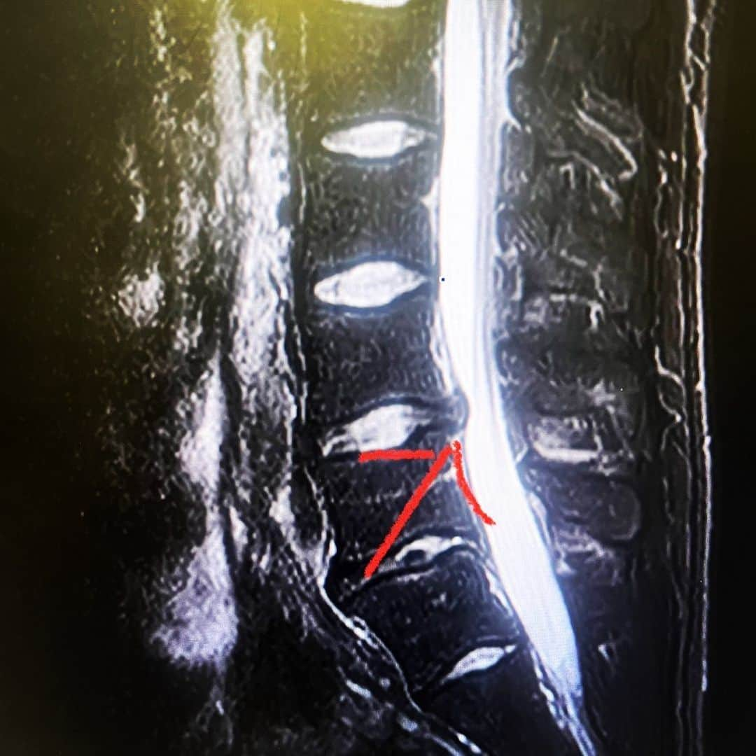 マキヒカのインスタグラム：「MRIの結果 腰が僕の身体をやめたがってました。本当に辛い。和倉ユースも出たかった。絶対復帰してウィナーズで試合でてちょんぼして相方のチャンネルで分析してもらえるように頑張ります。今はチームのために出来ること全力でします。腰が痛いって考えも出来れば他の部位が痛くなさすぎるっていう考えもできると思うんで。  #L5とS1Modicchange #椎間板ヘルヒカ #ウィナーズ #4 #怪我して思ったんはやっぱ俺チャンスやなと」