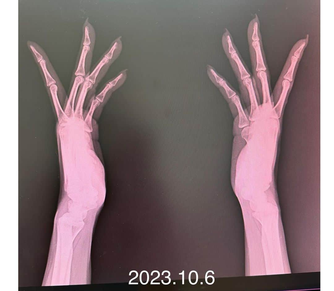金子エミさんのインスタグラム写真 - (金子エミInstagram)「6年後には指が曲がりますよ！とへバーデン結節の診察で言われてから、その6年目になりました。 ドキドキして今日レントゲン検診に行ってきました。  痛みが始まったのは2017年小指の第一関節が痛くなり、普段 携帯電話を小指で支えているから痛いのかなあ？ それから携帯の持ち方を注意をしていましたが、徐々に痛みが広がり痛み出してから1年後2018年には指の第一関節の全てが痛くなり、ペットボトルも開ける事が出来なくなる程になってしまったので、整形外科へ診察に行きました。 レントゲン検査では、異常はなく 年齢的なものですね！と言われ診察は終了。 えー！年齢的なものとしても、治療法はないの？ このまま痛いのは困るなぁ〜と。。  その時、近所のお母さんの第一関節が曲がった指を思い出し、もしかして！？と病院の帰り道に失礼かとも思いましたが、気心の知れているお母さんだったので 「指が痛かったか？」と聞きくと  「そう前は第一関節が痛かったの！でも曲がっちゃったらもう痛くないのよ。」と………えーー！！そんなーー  そっかー曲がったら痛くないのか！ でも曲がってほしくないな〜 何とか治療法がないのかと思い 手の外科専門医に再度診察へ行く事に。  手の専門医の先生に、この痛みの経過を話している途中に 「これですね！」と出された紙にはヘバーデン結節と書かれていました。 「小指から痛くなる事が多いんだよ！」 「このまま放置していたら6年後には指が曲がりますよと！」 言われものすごくショックだったことを10月になると思い出します。  手だけはやめて！と思いましたが 年齢的と言われると仕方ないのかなあ⁈とも思いましたが 先生に出された紙に書いてあったのは 納豆、豆乳、お豆腐に含まれるエクオールを摂ることを心がける事と、大塚製薬のエクエル飲むと、6割の人が痛みが無くなる。と  それからなるべく毎日 🔸豆腐3分の2丁 🔸納豆1パック 🔸豆乳200g 🔸大塚製薬　エクエル  2018年のレントゲンと比べて診断して頂き 発症から6年経った今 「変形は見られない！」という診断結果で安堵しています。  食べ物は豆腐、納豆、豆乳、厚揚げ、高野豆腐など 大豆イソフラボンを含む食べ物を毎日のようにいただき＋プラス 大塚製薬のエクエルを飲み続けてきた結果だと思ます^ ^🙌  これから私がどんなものを食べてきたのかを 少しずつ紹介していきますね。 身体の中に入れるもので、人間の身体は出来ているんだなぁ！と 改めて何を食べるのか？大切だと思うのでした。  克服したと言いたいところですが、閉経してからの5年は エクオール摂取を心がけたほうがいいと先生に言われました。 40歳を過ぎたらエクオールが特に女性には大切になりますね！  #手タレ#パーツモデル#なのに #へバーデン結節 #エクオール#大塚製薬 #エクエル #お豆腐#納豆#豆乳#高野豆腐 #エクエル #大豆イソフラボン #女性ホルモン#積極的に #指曲がらなかった」10月6日 16時21分 - emikaneko1114