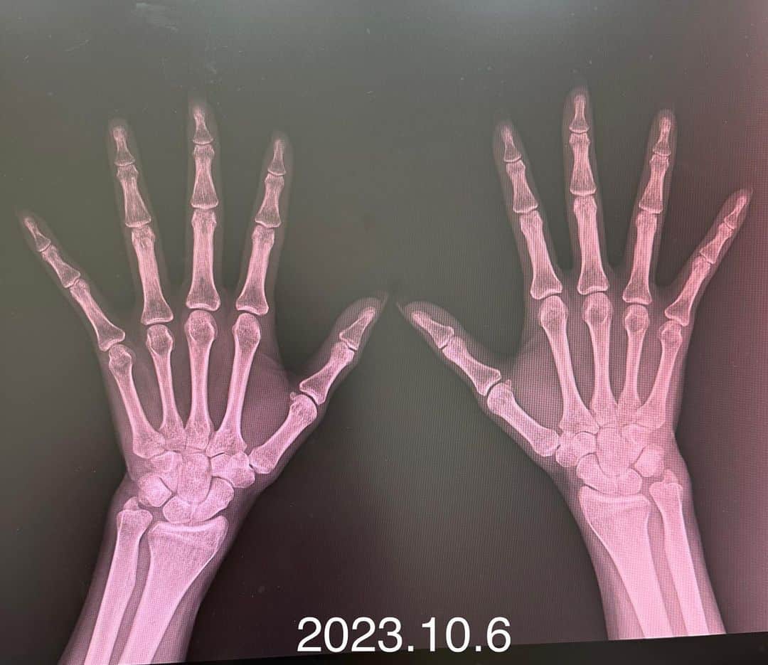 金子エミさんのインスタグラム写真 - (金子エミInstagram)「6年後には指が曲がりますよ！とへバーデン結節の診察で言われてから、その6年目になりました。 ドキドキして今日レントゲン検診に行ってきました。  痛みが始まったのは2017年小指の第一関節が痛くなり、普段 携帯電話を小指で支えているから痛いのかなあ？ それから携帯の持ち方を注意をしていましたが、徐々に痛みが広がり痛み出してから1年後2018年には指の第一関節の全てが痛くなり、ペットボトルも開ける事が出来なくなる程になってしまったので、整形外科へ診察に行きました。 レントゲン検査では、異常はなく 年齢的なものですね！と言われ診察は終了。 えー！年齢的なものとしても、治療法はないの？ このまま痛いのは困るなぁ〜と。。  その時、近所のお母さんの第一関節が曲がった指を思い出し、もしかして！？と病院の帰り道に失礼かとも思いましたが、気心の知れているお母さんだったので 「指が痛かったか？」と聞きくと  「そう前は第一関節が痛かったの！でも曲がっちゃったらもう痛くないのよ。」と………えーー！！そんなーー  そっかー曲がったら痛くないのか！ でも曲がってほしくないな〜 何とか治療法がないのかと思い 手の外科専門医に再度診察へ行く事に。  手の専門医の先生に、この痛みの経過を話している途中に 「これですね！」と出された紙にはヘバーデン結節と書かれていました。 「小指から痛くなる事が多いんだよ！」 「このまま放置していたら6年後には指が曲がりますよと！」 言われものすごくショックだったことを10月になると思い出します。  手だけはやめて！と思いましたが 年齢的と言われると仕方ないのかなあ⁈とも思いましたが 先生に出された紙に書いてあったのは 納豆、豆乳、お豆腐に含まれるエクオールを摂ることを心がける事と、大塚製薬のエクエル飲むと、6割の人が痛みが無くなる。と  それからなるべく毎日 🔸豆腐3分の2丁 🔸納豆1パック 🔸豆乳200g 🔸大塚製薬　エクエル  2018年のレントゲンと比べて診断して頂き 発症から6年経った今 「変形は見られない！」という診断結果で安堵しています。  食べ物は豆腐、納豆、豆乳、厚揚げ、高野豆腐など 大豆イソフラボンを含む食べ物を毎日のようにいただき＋プラス 大塚製薬のエクエルを飲み続けてきた結果だと思ます^ ^🙌  これから私がどんなものを食べてきたのかを 少しずつ紹介していきますね。 身体の中に入れるもので、人間の身体は出来ているんだなぁ！と 改めて何を食べるのか？大切だと思うのでした。  克服したと言いたいところですが、閉経してからの5年は エクオール摂取を心がけたほうがいいと先生に言われました。 40歳を過ぎたらエクオールが特に女性には大切になりますね！  #手タレ#パーツモデル#なのに #へバーデン結節 #エクオール#大塚製薬 #エクエル #お豆腐#納豆#豆乳#高野豆腐 #エクエル #大豆イソフラボン #女性ホルモン#積極的に #指曲がらなかった」10月6日 16時21分 - emikaneko1114