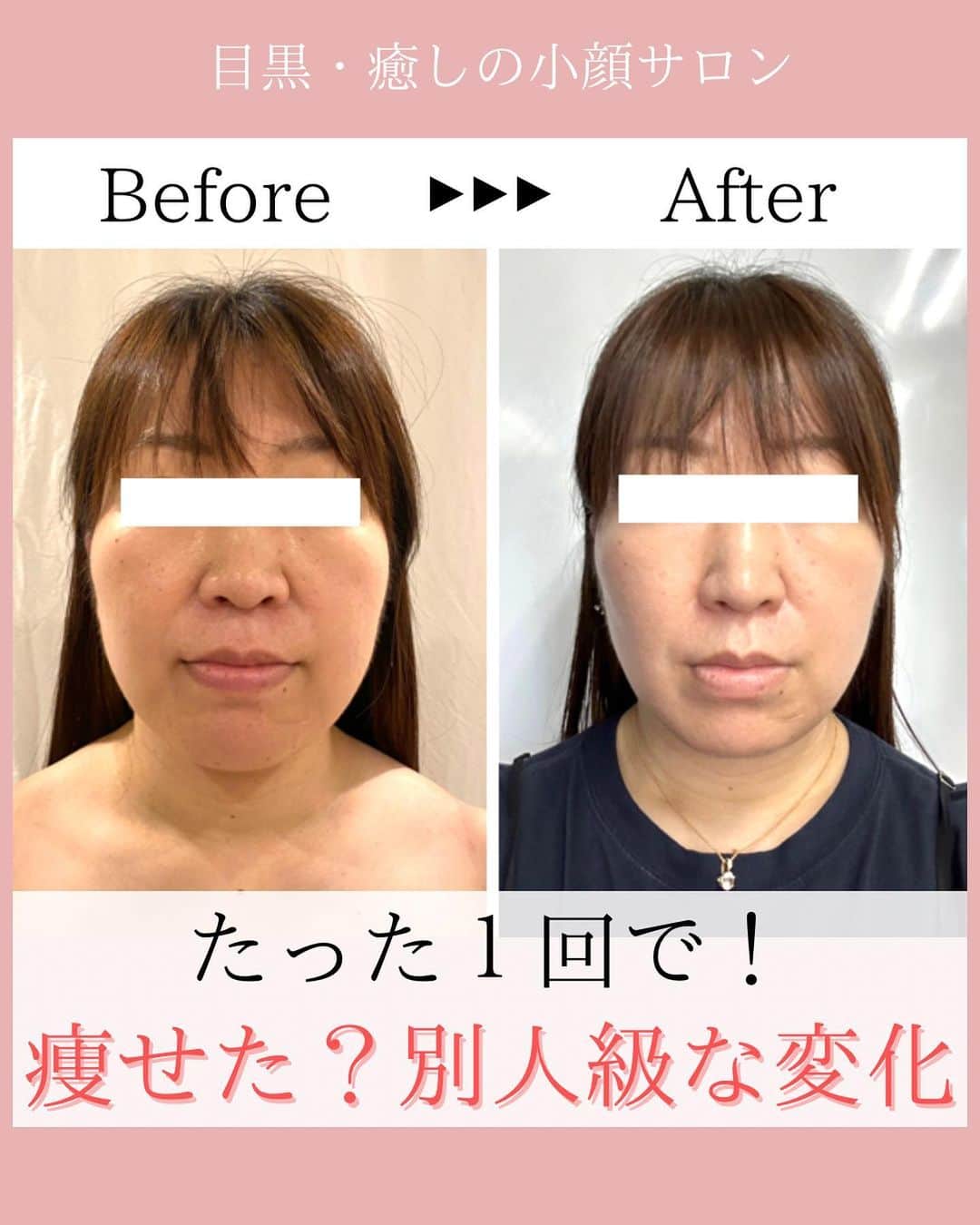 Eternal Total Beauty Salonのインスタグラム：「【痩せた！なんかやりました？透明感も出てる】⁣ ⁣ ⁣ ⁣ 1回目やった後から、美意識が高い周りの方に⁣気付いて頂けた様です😌⁣ ⁣ ⁣ ⁣ ダイエットをしなくても⁣ お顔はまるで痩せたかのように厚みが減ったり⁣ 継続していく事でだんだんと⁣ むくみにくくもなっていきますよ⁣ ⁣ ⁣ ⁣ ご本人も触った感覚がスッキリしている事と⁣ 首肩周りが出てきたこと⁣ 目が開きやすくなったことにも⁣ ⁣ 喜んでくださっていました✨⁣ 顎の長さにもご注目です！！⁣ ⁣ ⁣ ⁣ ⁣ 何歳からでも変われます🕊️⁣ 『私の顔は生まれつきだから変わらないだろう』⁣ ⁣ と諦めの気持ちがある方にこそ⁣ 受けて頂きたいです⁣ ⁣ ⁣ お顔が変わると意識も変わり⁣ 意識が変わると行動も変わる💓⁣ ⁣ ⁣ ⁣ ⁣ ⁣ ⁣ ⁣ ⁣ ⁣ ⁣ 【小顔効果倍増なペース】⁣ ＊初回から含めて3回目までは週1から空けても2週に1回のペースを推奨しております。⁣ 最初に土台を作り戻りにくく定着させる為です。⁣ ⁡⁣ ご新規様は3回分のご予約をオススメ致します。トップページのLINEから承っております🙇‍♀️⁣ ⁡⁣ ⁣ ⁣ ⁣ 🌹オールハンド60分(ヘッド、小顔矯正、オイル)初回¥15000⁣ ⁣ 🌹インディバ付き90分(ヘッド、小顔矯正、インディバ、オイル) 初回¥20000⁣ ⁣ ⁣ ⁣ ⁣ ⁣ ＊＊＊＊＊＊＊＊＊＊＊＊＊＊＊＊＊＊＊＊⁣ ⁣ ⁣ 小顔矯正/インディバ⁣ ⁣ ⁣ 営業時間　11:00〜20:00(18:30最終受付)⁣ ⁣ 定休日　不定休⁣ ⁣ ⁣ ご予約はDMもしくはLINEから🙇‍♀️✨⁣ 【@beautylian_kogao】⁣ ⁣ ＊＊＊＊＊＊＊＊＊＊＊＊＊＊＊＊＊＊＊＊⁣ ⁣」