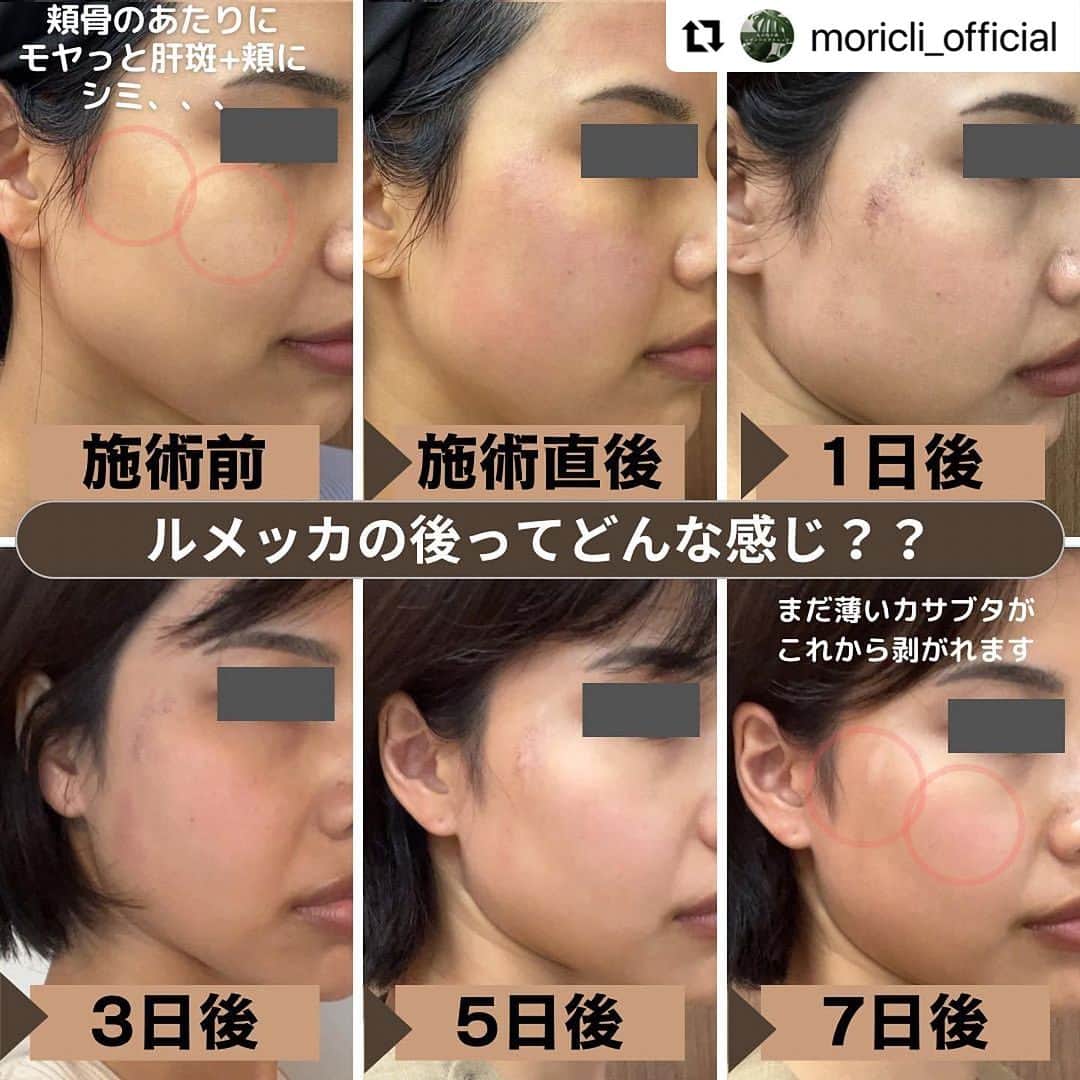 宋美玄のインスタグラム：「#Repost @moricli_official with @use.repost ・・・ 当院でも人気の高い施術のルメッカについて、経過レポさせていただきます🙇‍♀️  beforeでは、明らかな目立つシミはないものの、頬骨〜こめかみあたりにうっすら肝斑の様なものと、頬に小さなシミが点在していました。  ルメッカ照射直後の全体の赤み、ヒリつきは、当日中にはだいたい治ります。 部分的な赤み、ヒリつきは、数日続くことも。  当日〜翌日に薄いカサブタができる場合もあります。 その場合は1週間〜10日位ではがれ落ちていきます。  照射から2週間前後で、お肌の状態がいいかも？トーンアップした？？というような実感得られる場合が多いです。  日差しが落ちついてきた、今の時期がシミ治療の始めどきです💆‍♀️  しかも！！ 今ならお得にルメッカを始められるキャンペーン中！！  ぜひお試しください💁‍♀️  #丸の内の森レディースクリニック #丸の内#東京 #レディースクリニック#婦人科#ピル #美容#美容皮膚科#スキンケア#シミ#シミ治療 #フォトフェイシャル#ipl#ルメッカ #秋」