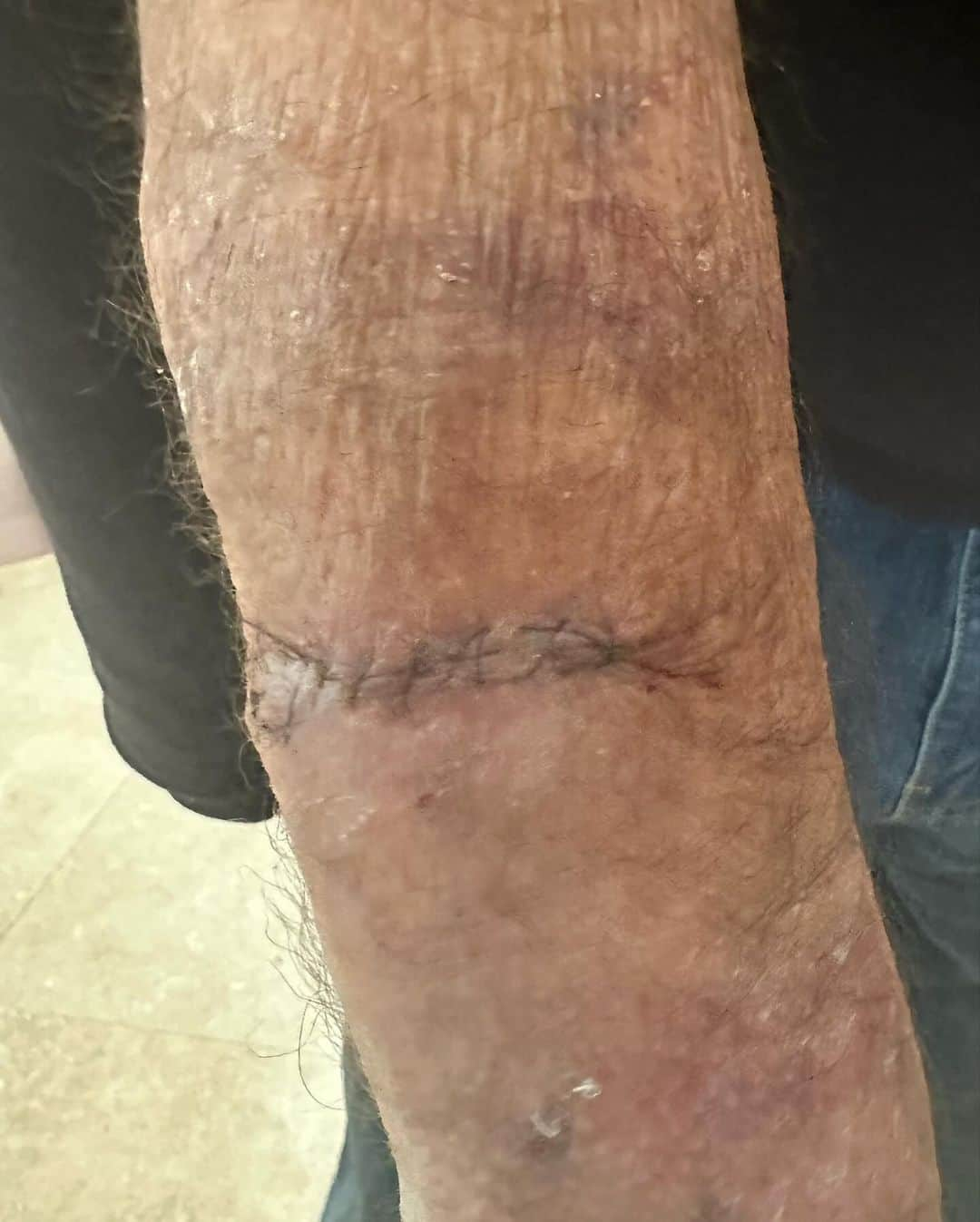 Marianna Hewittさんのインスタグラム写真 - (Marianna HewittInstagram)「a few weeks ago my dad came up to have lunch with me and he pointed out a spot on his arm. When I saw it I immediately knew what it was and made an appointment to see a dermatologist, who then did a biopsy and found out it was skin cancer.  He just had it removed (swipe, but warning it’s stitches) but sharing this as a reminder to please wear sunscreen everyday. The best sunscreen is the one you want to wear. I don’t care which you choose mineral or chemical — something is better than nothing. I just encourage you to find one you don’t mind applying everyday — and remember to get your skin checked with your dermatologist annually and if you see anything unusual, get it checked it out. 🤍  Also my dad is doing fine! he’s also had a cancer of the eye and prostate cancer, both of which he is diligent with follow up’s post radiation to monitor.」10月7日 2時26分 - marianna_hewitt