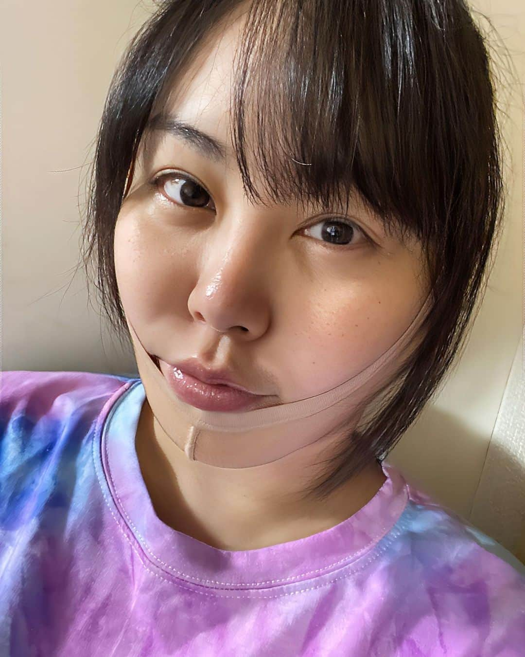 AD久保田（久保田樹里）のインスタグラム：「2023.10.5 手術当日（糸リフト+顎下の脂肪吸引）  イセアクリニックの中村先生はじめ、 @nakamura_isea  看護師さんに手厚く手術を担当して頂きました。 ありがとうございました。  仕上がり感想はまたまだかかりそうです。  手術の感想。 めちゃ一例です！個人的な見解。  私の場合、血管が細いので絶水をしているとより血管が見えにくいので看護師さん困らせタイムでした。  更に今回静脈麻酔を使いましたが、院により種類が違うのかな？めちゃ効かなくて（体質だと思いますが、私お酒飲まないからアルコールの強さは関係ない。太ってるからって説もある。）あまりに正気だったので、先生が麻酔の種類を変えて下さいました。 ここまで麻酔効かない自分は希少な気もします（笑） 意識は落ちたり痛い!って戻ったり。でもいつ手術終わったか全然わからないくらい最後の記憶ないです。笑  麻酔が覚めるまでゆっくりしてくださいと言って頂き激サムだったので毛布かけて頂きました。 完全に麻酔が覚めるまでゆっくりしたかったのですが、尋常じゃなくお手洗いに行きたくて🌱笑 看護師さんに付き添って頂き🚽行って、先生と看護師さんにDTの過ごし方、抜糸についてなどご説明して頂きました。  帰りは私は麻酔も覚めるのが早い方なのか？フラフラもなく電車で帰りましたが、麻酔苦手な方はタクシー🚕🚖をオススメします。 バンドを顔にしていましたがフーディーだけで帰宅。※私みたく他人の目を気にしないタイプは少ないかもです。  術後24時間は着圧バンド取れません。 看護師の友達に聞いたら、傷の修復にタンパク質がいいとの事で買い込みました。 あとは冷やして、24時間後の洗顔待ちです。  質問があった痛みについて… 手術中は多分麻酔が効かない体質なので、多少人より痛みを感じたかも？ですが、我慢の出来る範囲。 帰宅してからは何処が痛いか？ってよりバンドの圧で頭いてぇ。 飲み物もストローを使うけど、吸うのが痛いからめちゃYouTubeで調べてストローうまく使い水分補給。 あとはウィダー押し込み。  こんな1日でした。元気でした☺️  #イセアクリニック  #脂肪吸引  #糸リフト  #糸リフトダウンタイム  #脂肪吸引ダウンタイム  #若返り」