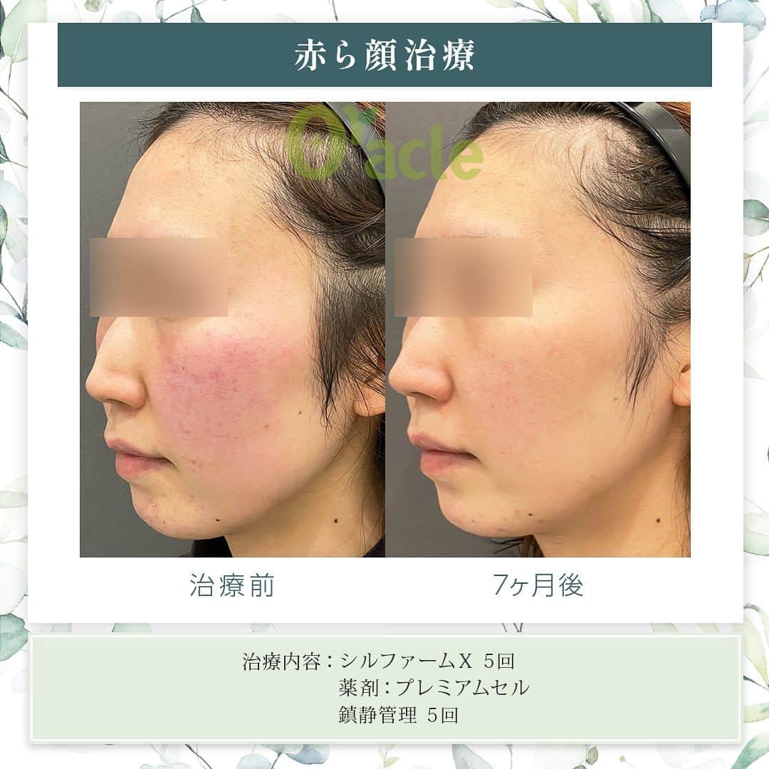 オラクル美容皮膚科東京新宿院さんのインスタグラム写真 - (オラクル美容皮膚科東京新宿院Instagram)「|◤赤ら顔の治療症例◢| 《治療内容》 シルファームX 5回 薬剤☞プレミアムセル 鎮静管理5回  ☑️シルファームX シルファームXは8つの異なるモードを搭載した最新のマイクロニードルRF（高周波）治療です。  世界初のパルスRFモードが搭載されていており、このモードは特に肝斑や赤みの改善に効果を発揮します。  【仕組み】 ①RF（高周波）で熱を加える　 →コラーゲン増生を促し肌を再生 →異常血管を壊し赤みを消していく  ②マイクロニードル（極細の針） →RFで熱を加えながら針で皮膚に穴をあけて肌を修復  ①②によりお肌の弾力がアップし、毛穴の引締め、ニキビ跡の改善、肝斑、小じわの改善、赤みの改善といった幅広い症状の改善が期待できます。  【料金】 全顔1回　25,000円（税込） ※別途、麻酔代2,200円 ※各コース割引ございます。  ⚠️ダウンタイムなど 赤み：2〜3時間　 ※個人差大きく赤みが強く出る方もいます 浮腫み、皮剥け：出る方もいる 洗顔、翌日 ダウンタイムは比較的少ない治療ではし  ▶︎鎮静管理　1回11,000円　 →オプションの場合7,700円 フラクセル後はお肌に熱がこもった状態になります。マイナス15度で冷やしながら鎮静保湿成分を導入する韓国式の治療です。 ⁡ #赤ら顔　#赤ら顔治療 #シルファーム #シルファームx #顔の赤み #皮膚科 #美肌 #美白 #マイクロニードルRF #高周波」10月8日 18時19分 - oraclejp