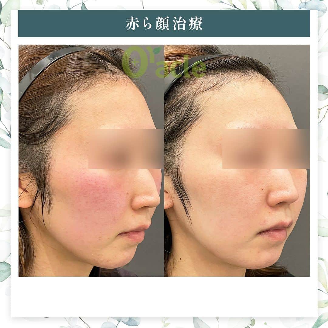オラクル美容皮膚科東京新宿院さんのインスタグラム写真 - (オラクル美容皮膚科東京新宿院Instagram)「|◤赤ら顔の治療症例◢| 《治療内容》 シルファームX 5回 薬剤☞プレミアムセル 鎮静管理5回  ☑️シルファームX シルファームXは8つの異なるモードを搭載した最新のマイクロニードルRF（高周波）治療です。  世界初のパルスRFモードが搭載されていており、このモードは特に肝斑や赤みの改善に効果を発揮します。  【仕組み】 ①RF（高周波）で熱を加える　 →コラーゲン増生を促し肌を再生 →異常血管を壊し赤みを消していく  ②マイクロニードル（極細の針） →RFで熱を加えながら針で皮膚に穴をあけて肌を修復  ①②によりお肌の弾力がアップし、毛穴の引締め、ニキビ跡の改善、肝斑、小じわの改善、赤みの改善といった幅広い症状の改善が期待できます。  【料金】 全顔1回　25,000円（税込） ※別途、麻酔代2,200円 ※各コース割引ございます。  ⚠️ダウンタイムなど 赤み：2〜3時間　 ※個人差大きく赤みが強く出る方もいます 浮腫み、皮剥け：出る方もいる 洗顔、翌日 ダウンタイムは比較的少ない治療ではし  ▶︎鎮静管理　1回11,000円　 →オプションの場合7,700円 フラクセル後はお肌に熱がこもった状態になります。マイナス15度で冷やしながら鎮静保湿成分を導入する韓国式の治療です。 ⁡ #赤ら顔　#赤ら顔治療 #シルファーム #シルファームx #顔の赤み #皮膚科 #美肌 #美白 #マイクロニードルRF #高周波」10月8日 18時19分 - oraclejp