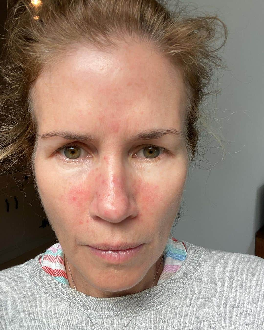 グッチ・ウェストマンのインスタグラム：「Finally feeling comfortable without makeup has been a journey! 😬 Looking back at what my skin was like about a year ago to this morning! Battling the frustrations of rosacea has never been easy, but since I streamlined my skincare routine to just using our Skin Activator serum, I've see the biggest change. Swipe for more before & afters and I'd love to see yours! ➡️ Nothing's ever perfect, but I'm consistently blown away by these results. 💕 xx」