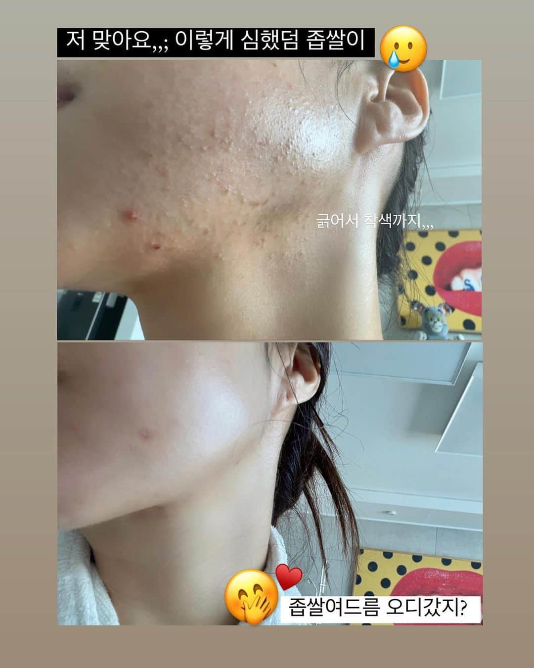 チョ・ミニョンさんのインスタグラム写真 - (チョ・ミニョンInstagram)「#주의 저의 자극적 비포에프터가 있음 #쌩얼 자연광이 더예쁜 '뿌리는 보톡스 부스터! 나노 시카 엑소좀 줄기세포 미스트🌷  🎶#좁쌀 #여드름 퇴치템!  👉🏻옆으로 넘겨서 저 좀 봐주세요 ⠀⠀⠀⠀⠀⠀⠀  구매하신 분들 아낌 없이 뿌리세요 아끼면 안되요! 😡그 이유는 ❓   휴가 다녀와서 회복도 안 된 피부에 환절기 맞이한 시점  ️지금❗️ 수분+ 진정+영양❗️ 공급을 안해주면 정말 하루 아침에 잔주름이 늘어 나는 중요한 시기인 만큼   아침 저녁 집에서 홈케어 하는 것만큼이나 수시로 뿌려주는 수분영양공급+ 보호막이 중요해요 갑자기 바뀐 날씨와 기온 온도 습도 우리 피부는 한 없이 예민해요☺️  저는 쉬지 않고 뿌려줘서 제 피부는 오히려 더 좋아졌고 환절기인 지도 모를 정도에요 :)   기존 앰플로 나오 시카 엑소좀에 크림한 통 원터를 그대로 녹여서 만든 크림 미스트 제형으로 뿌릴 수록 속부터 꽉 차는 깊은 수분 보습과 윤광에  잔주름 굵은 주름 모공까지 팽팽하게 해주는 " 스위스 " 고품질 특허원료인 SYN-COLL 성분이 고함량 25.000PPM !!!!  손상된 피부에 효과적 진정과 수분 공급은 해주면서 잔주름 모공과 처진 피부는 보톡스 및 줄기세포 성분이 채워주면서 쫀쫀하게 올라가는 피부맛,,, 이모든게 가능한 이유는?  모공보가 215배 작은 나노미스트라 크리미한실크한 제형이여도 흡수도 너무 잘되고  뿌리고 난 후 피부 장벽 보호막까지 완벽하게 해준답니다  공구는 오늘까지랍니다 악건성에 건조학고 가렵고 주름이보이는 분들 🌷어서 달려오세요🌷」10月12日 13時02分 - xxjominxx